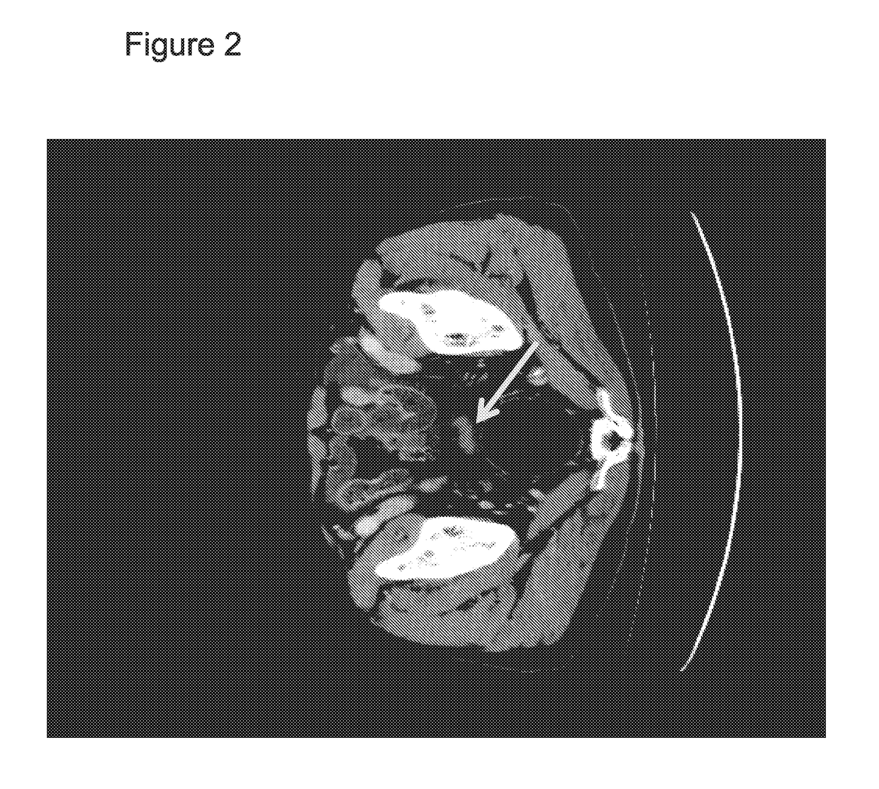 Therapeutic agents for pancreatic cancer