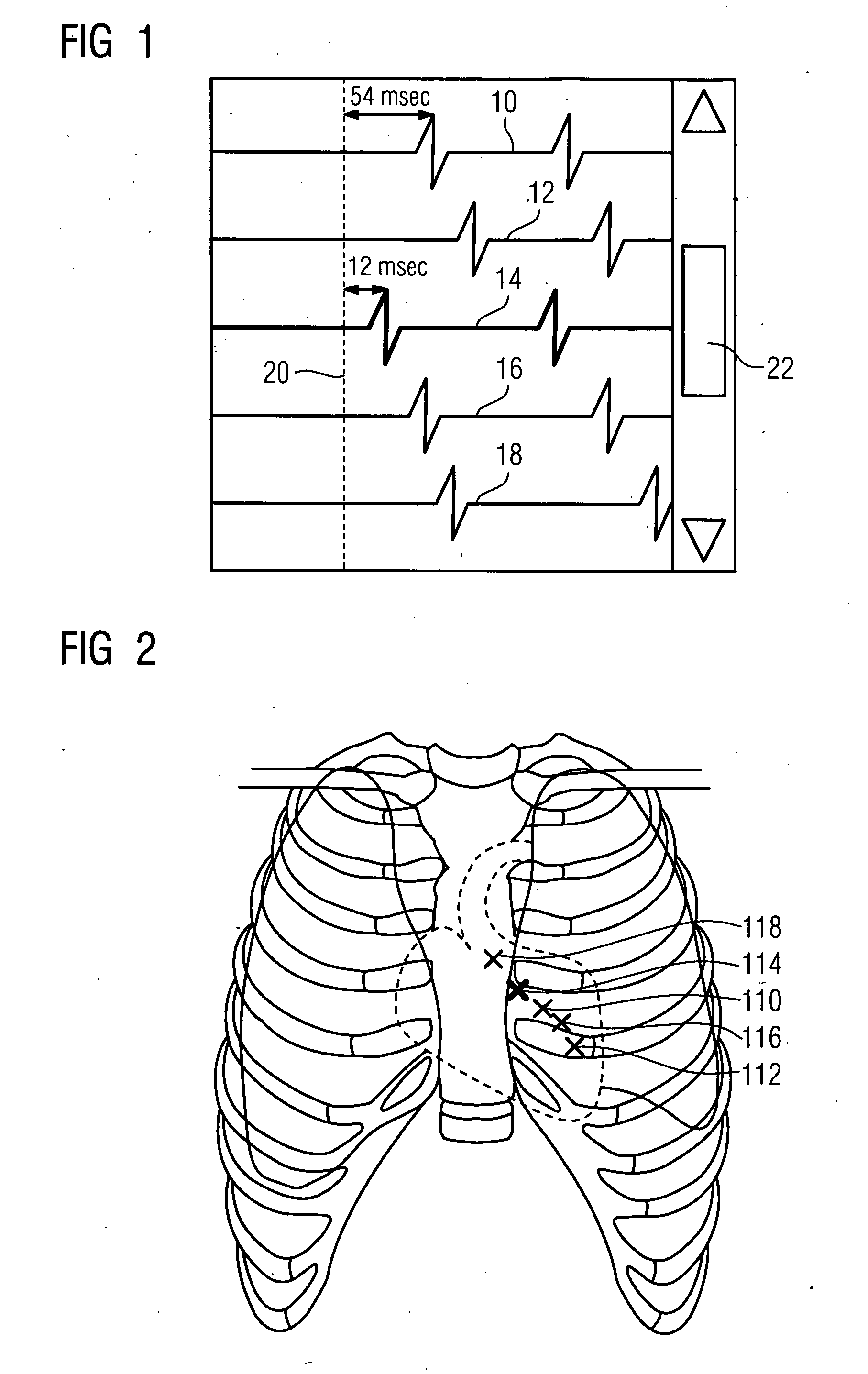 Method for providing measuring data for the precise local positioning of a catheter