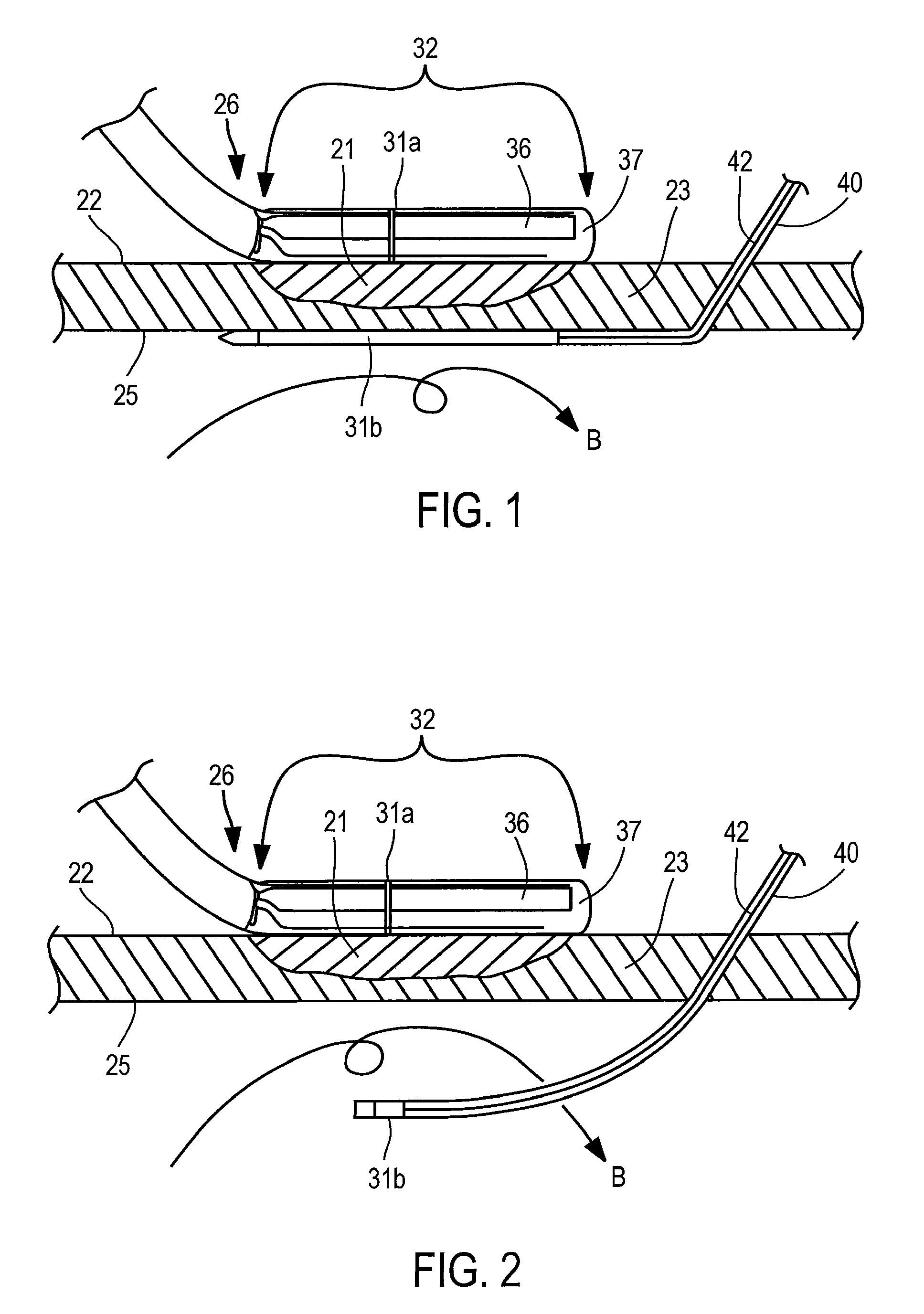 Apparatus and method for assessing transmurality of a tissue ablation