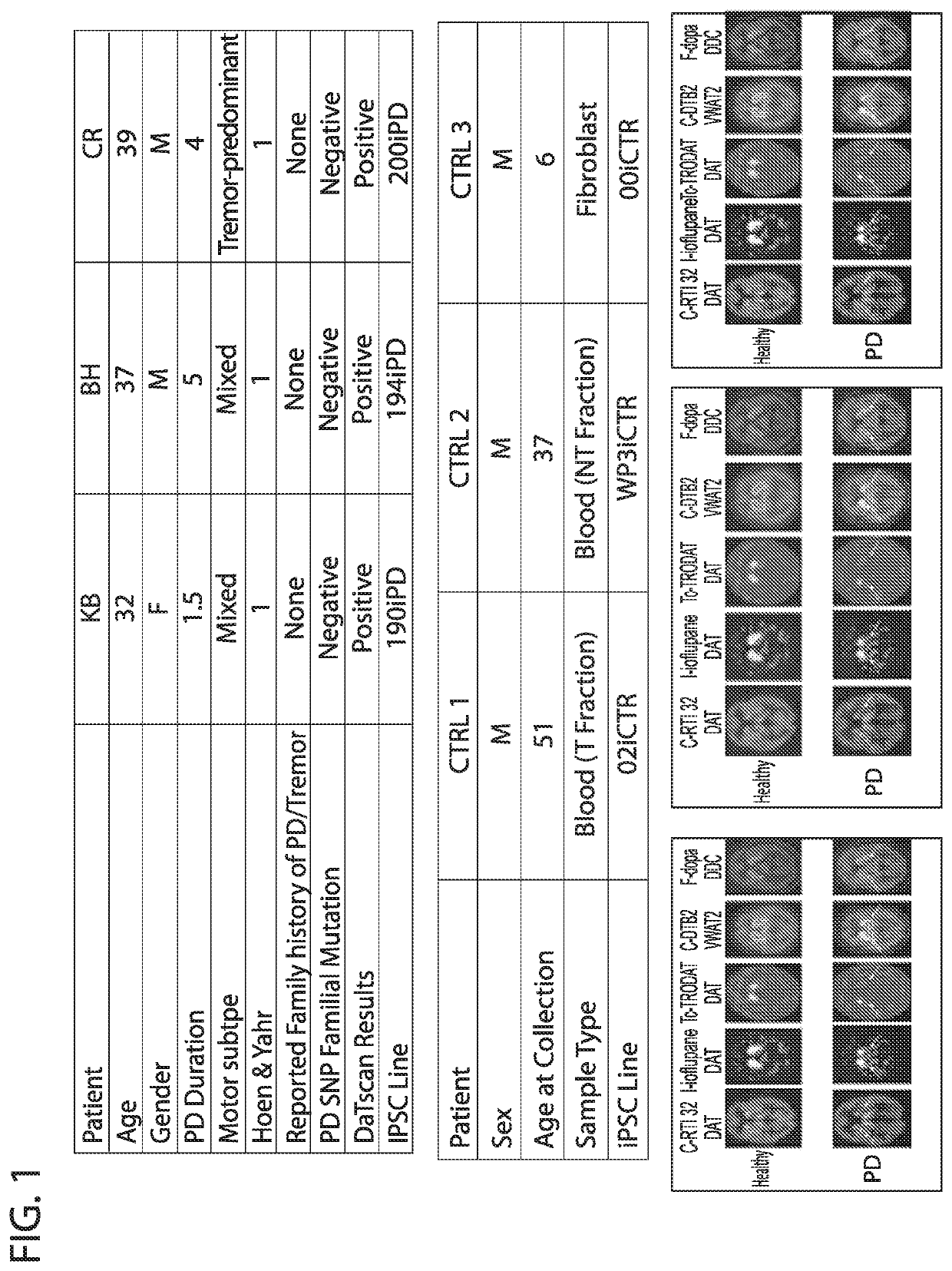 Novel differentiation technique to generate dopaminergic neurons from induced pluripotent stem cells