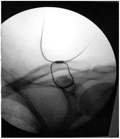 Coracoclavicular ligament titanium cable reconstruction guider and reconstruction method for coracoclavicular ligament