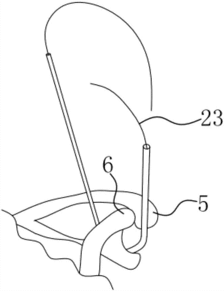 Coracoclavicular ligament titanium cable reconstruction guider and reconstruction method for coracoclavicular ligament