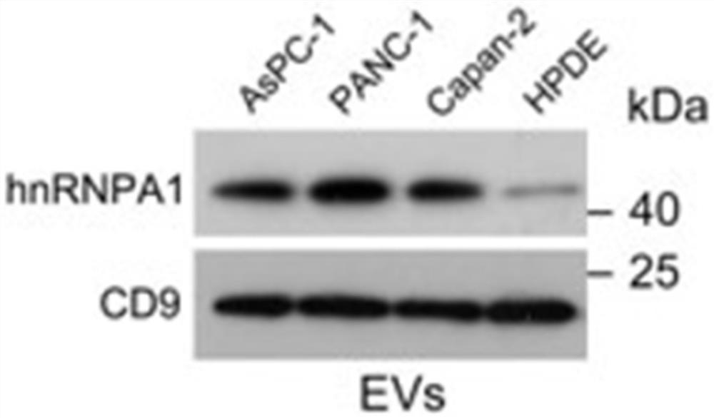 Application of hnRNPA1 in diagnosis, prognosis and treatment of pancreatic cancer