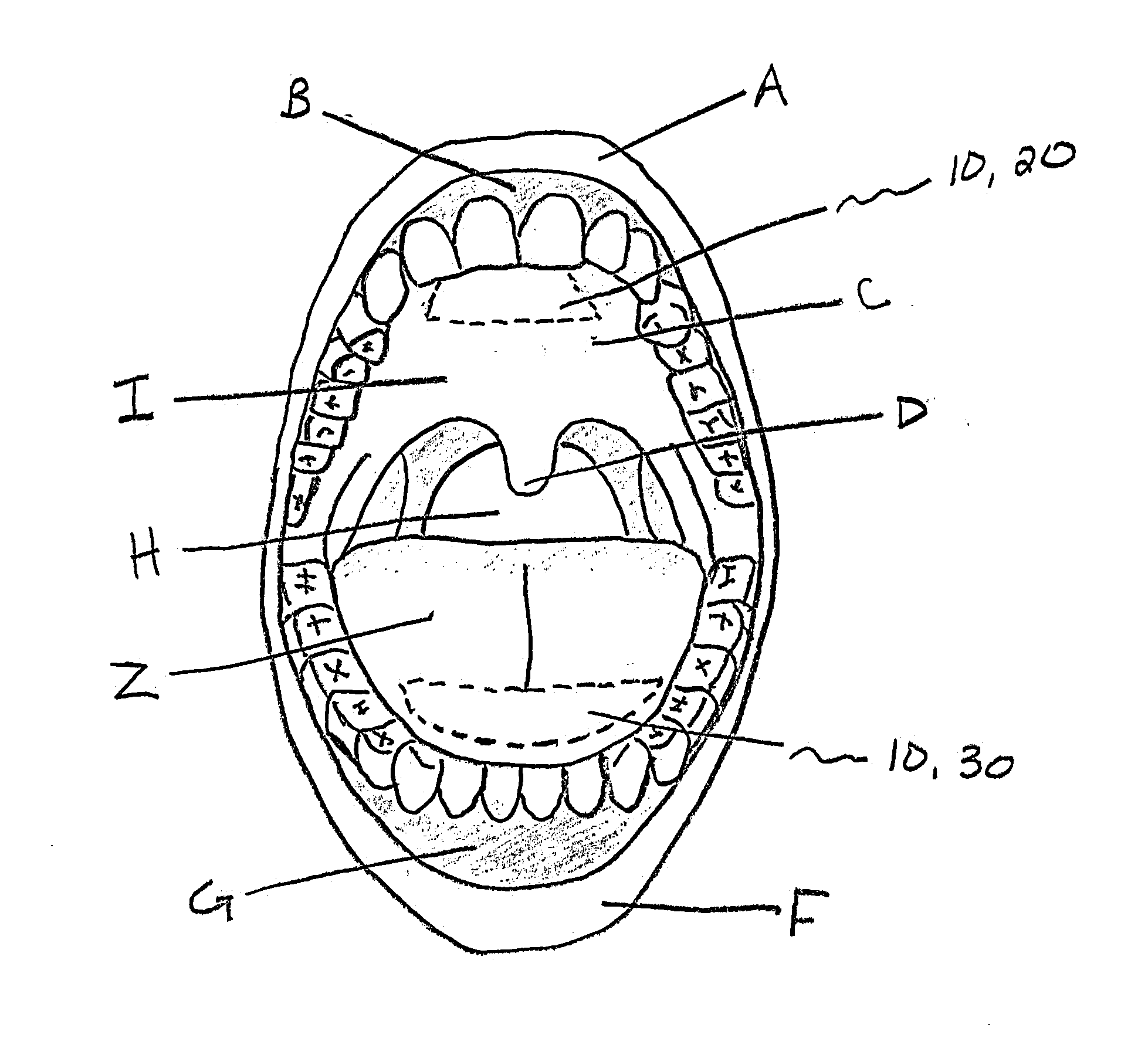 A MucoAdhesive Tongue Strip Used As A Method to Prevent Snoring and Sleep Apnea During Sleep