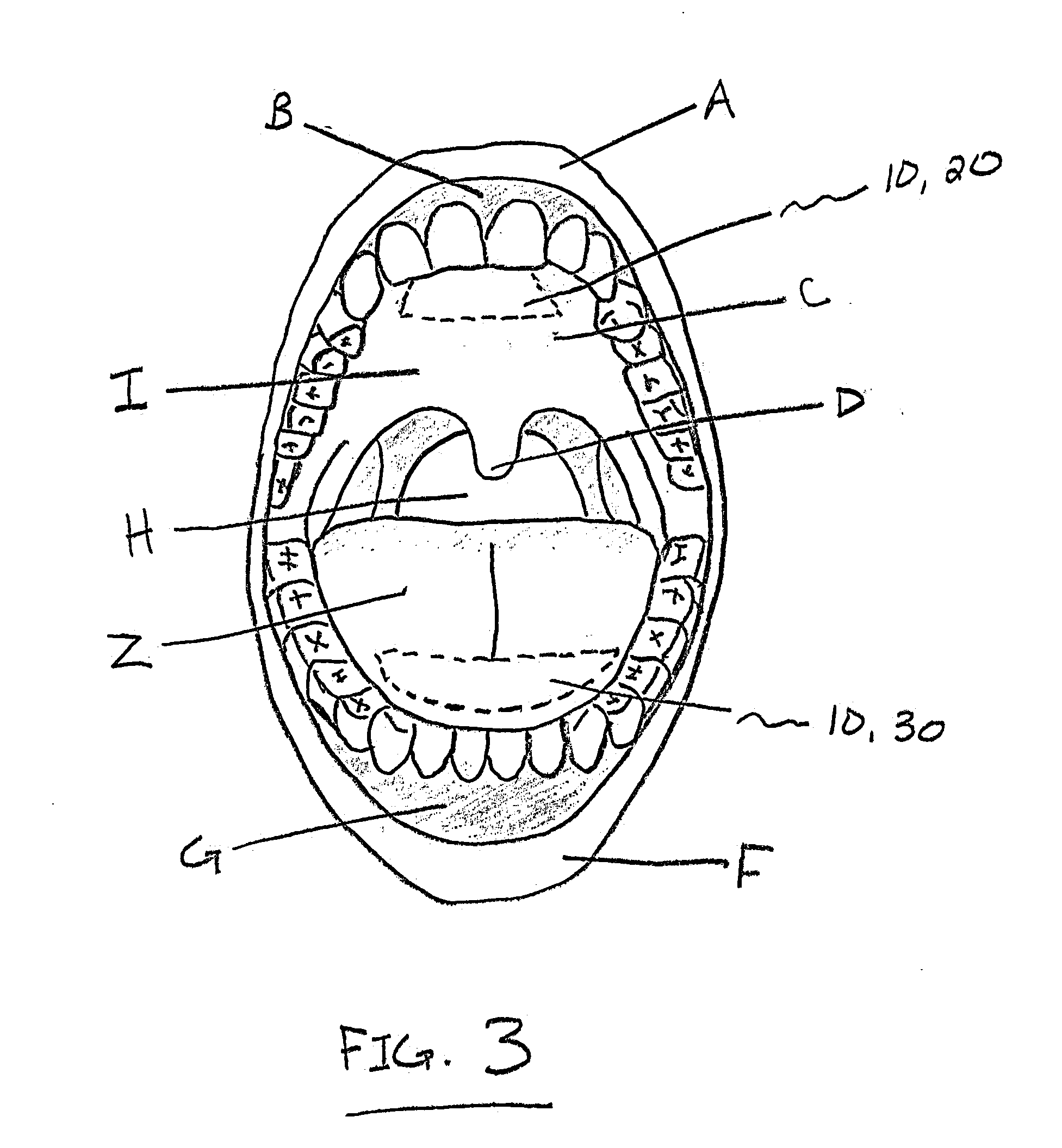 A MucoAdhesive Tongue Strip Used As A Method to Prevent Snoring and Sleep Apnea During Sleep