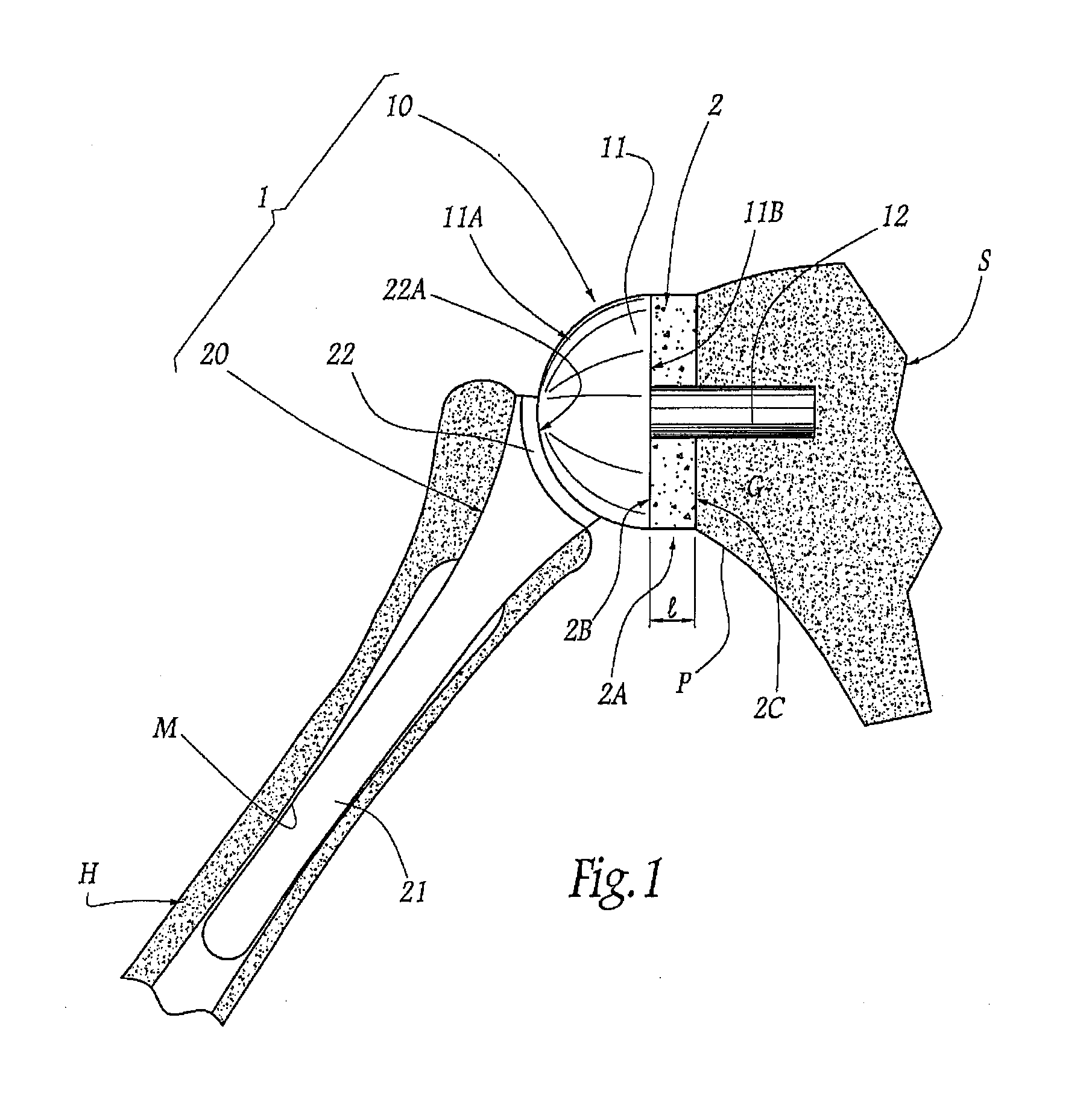 Apparatus for fitting a shoulder prosthesis