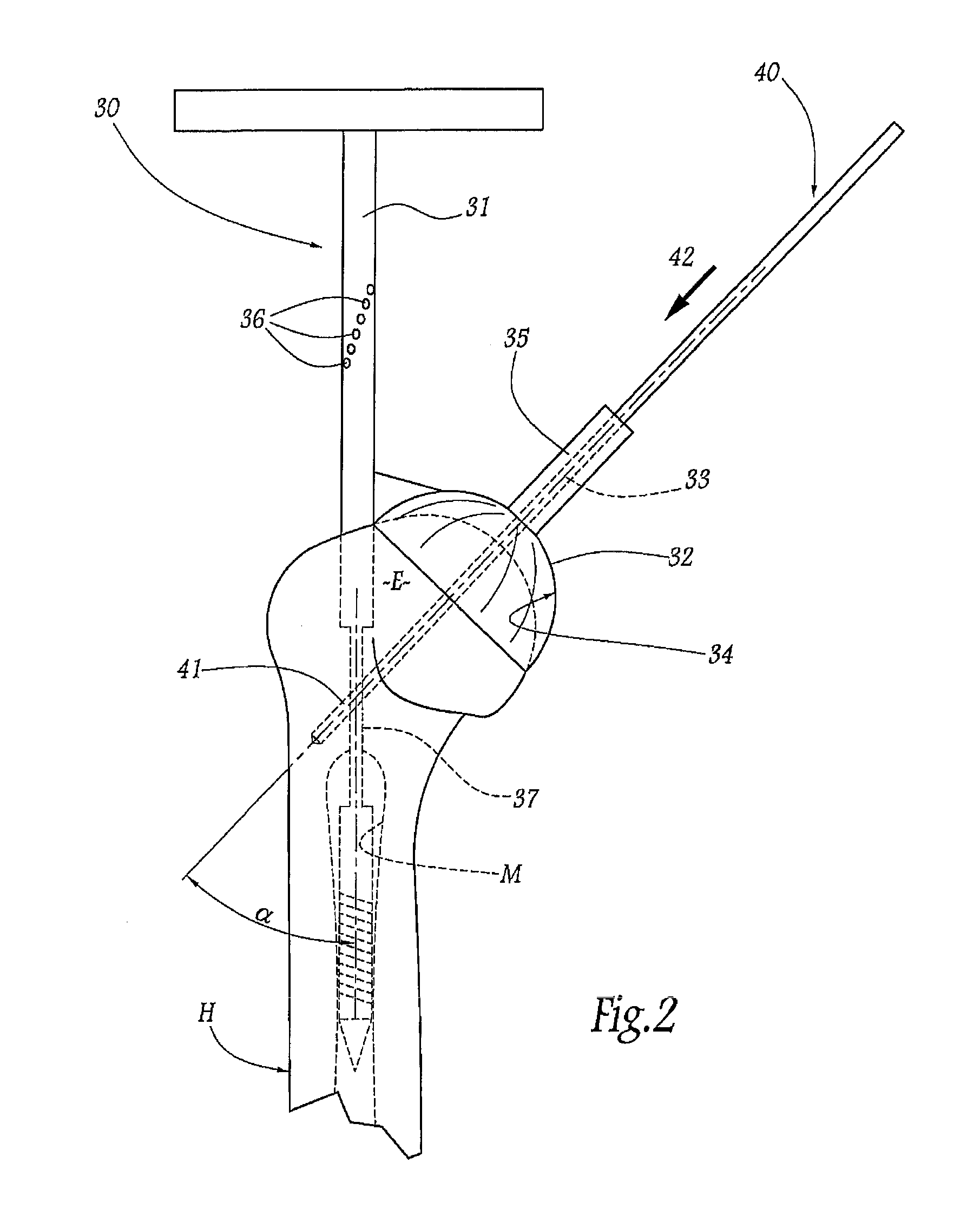 Apparatus for fitting a shoulder prosthesis