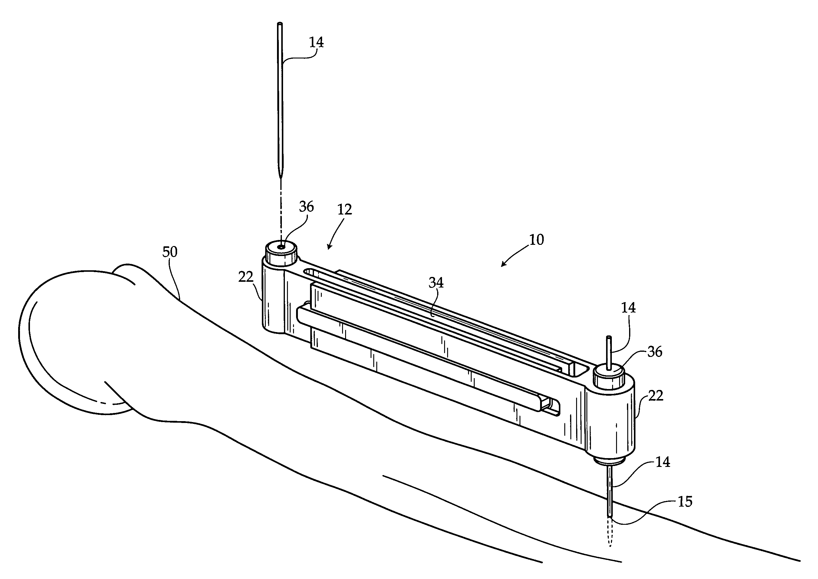 Adjustable osteotomy guide