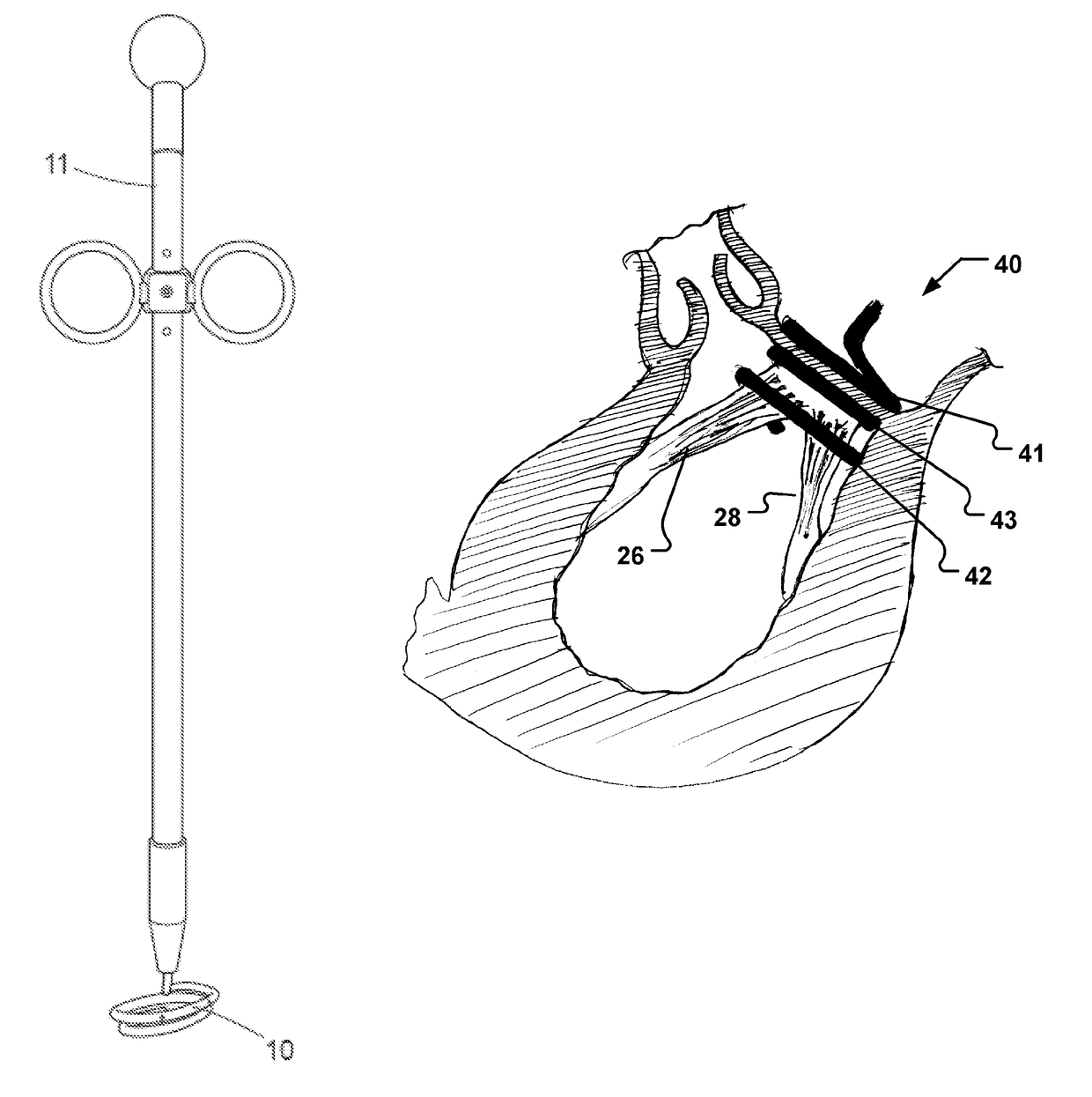 Cardiac valve downsizing device and method