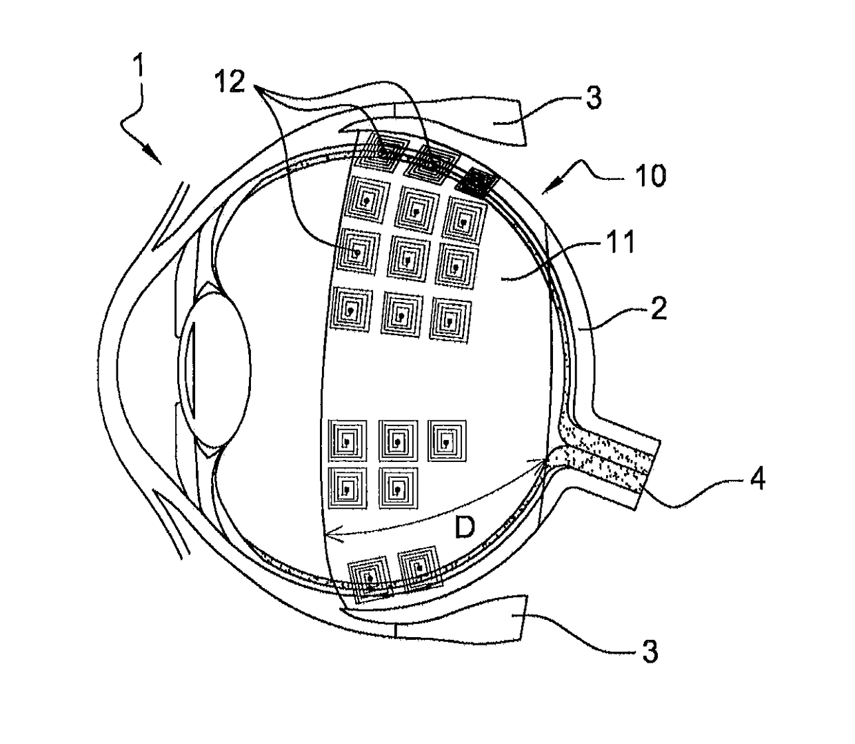 Device and method for prosthetic rehabilitation of the retina