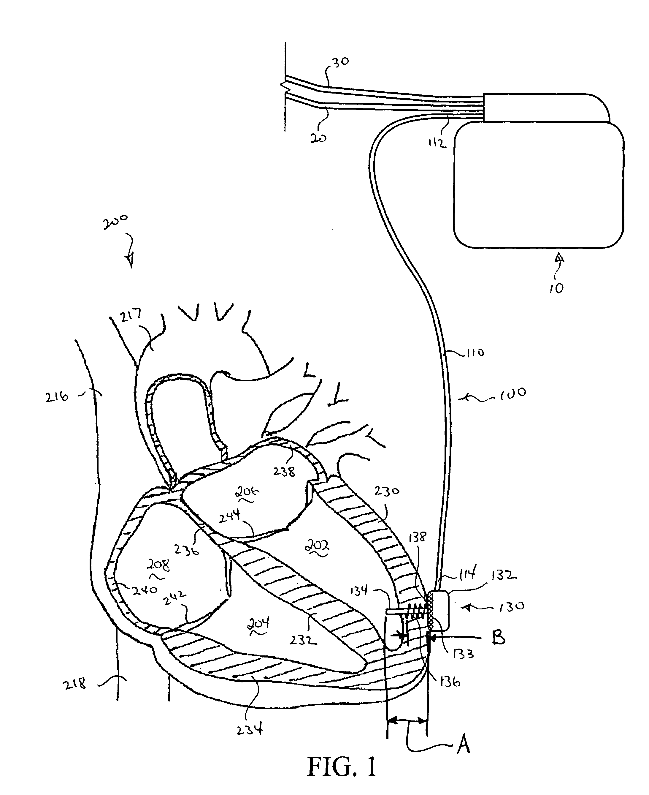 Implantable pressure sensor with pacing capability