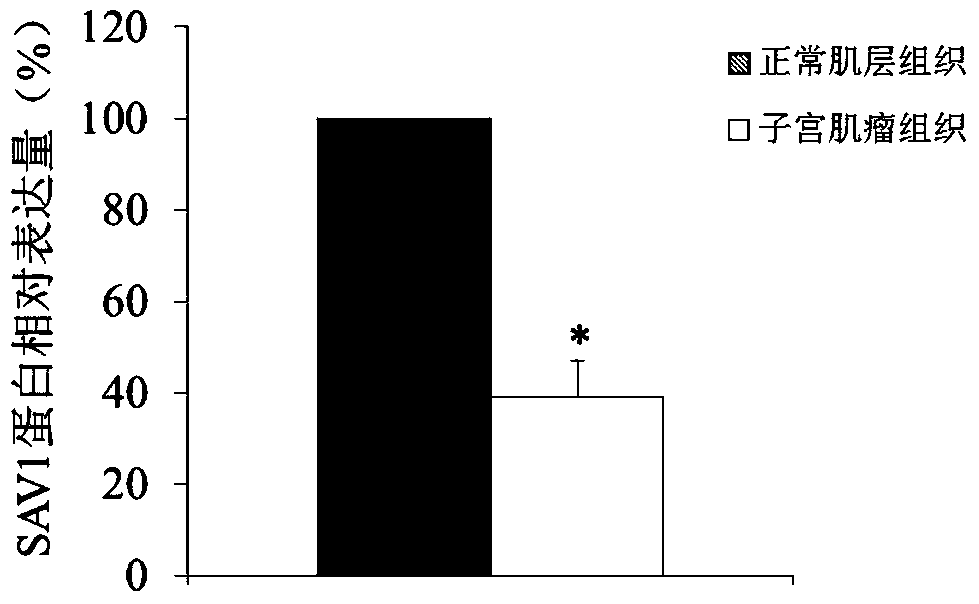 Use of sav1 gene as a marker for diagnosis and treatment of uterine fibroids