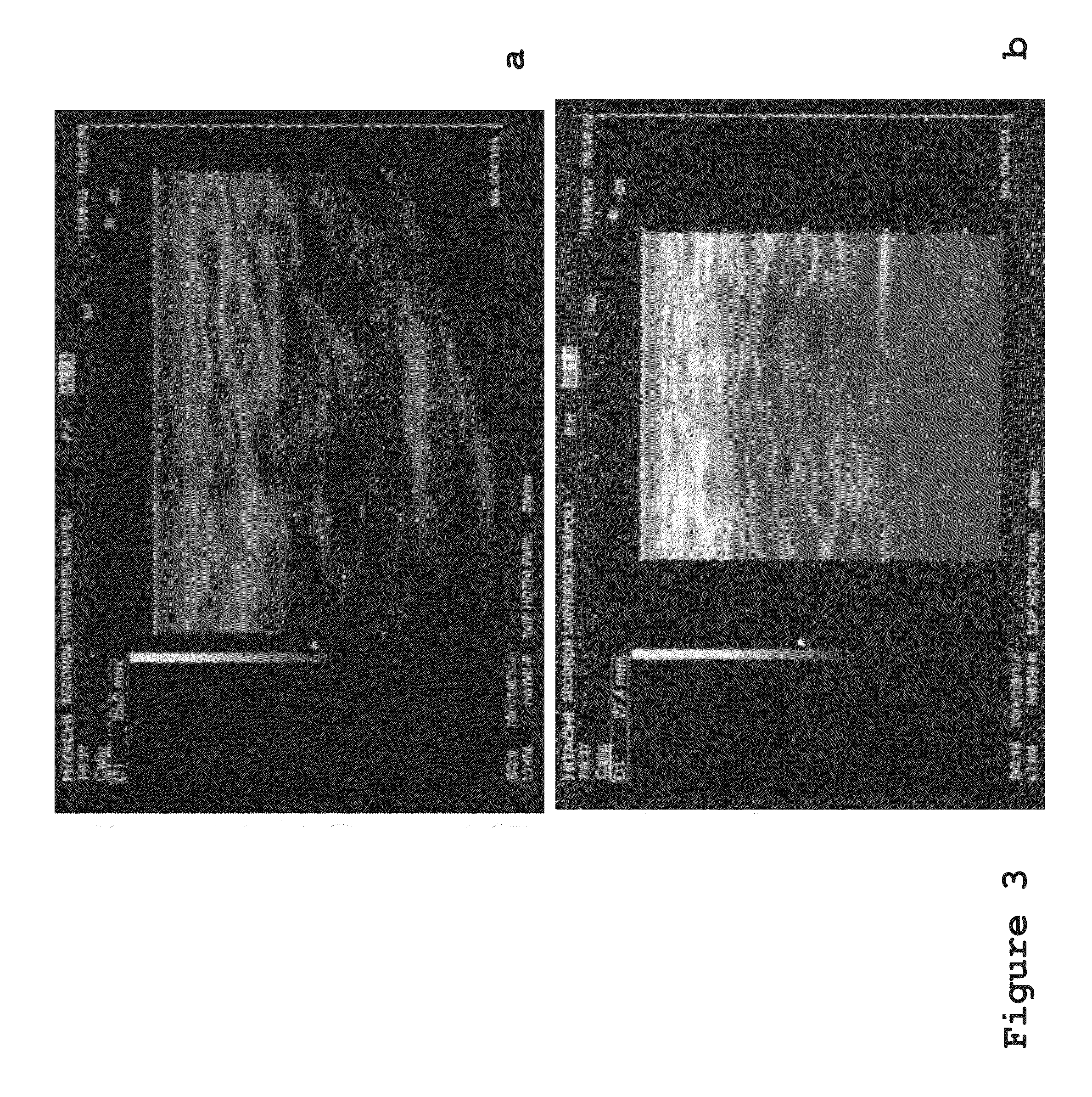 Method for the non-surgical treatment of lipodystrophy in a retrovirus-infected individual