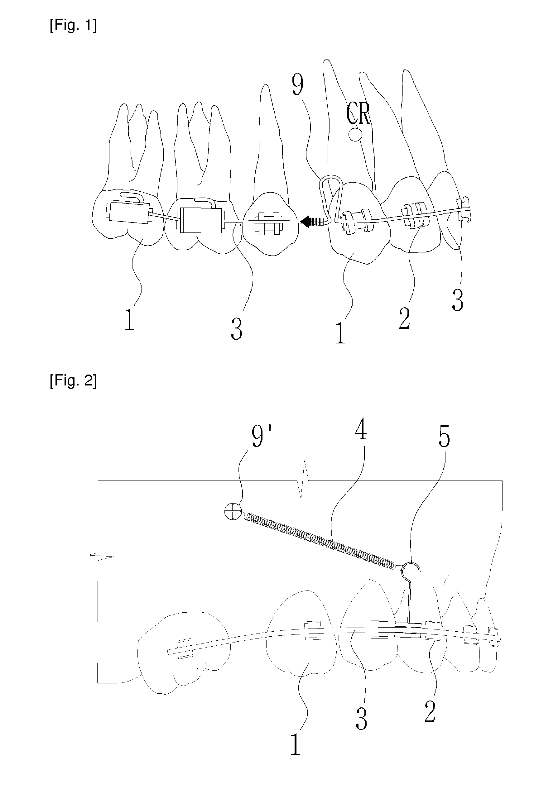 Connection device for surgical operation of straightening irregular teeth