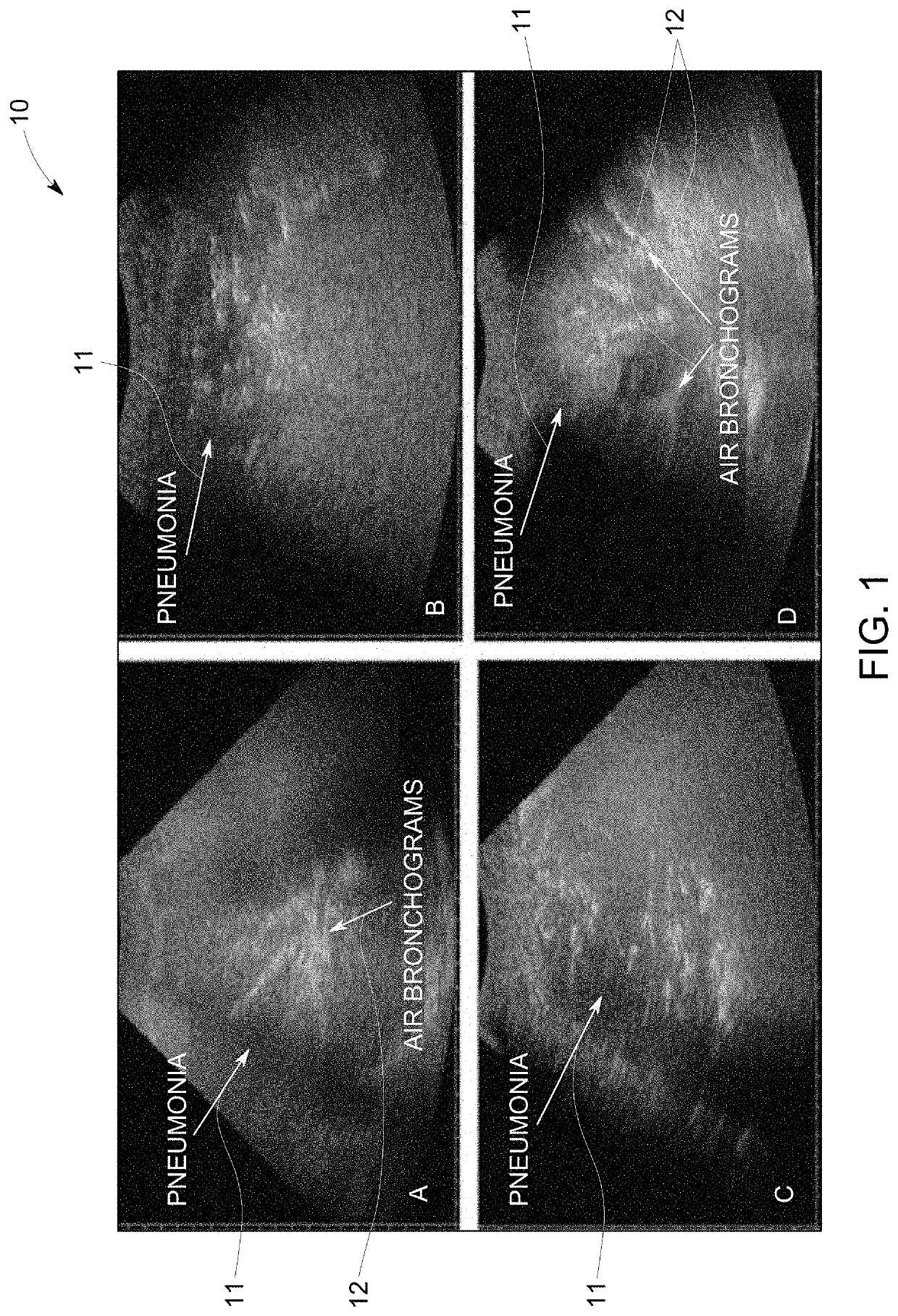 Guided lung coverage and automated detection using ultrasound devices
