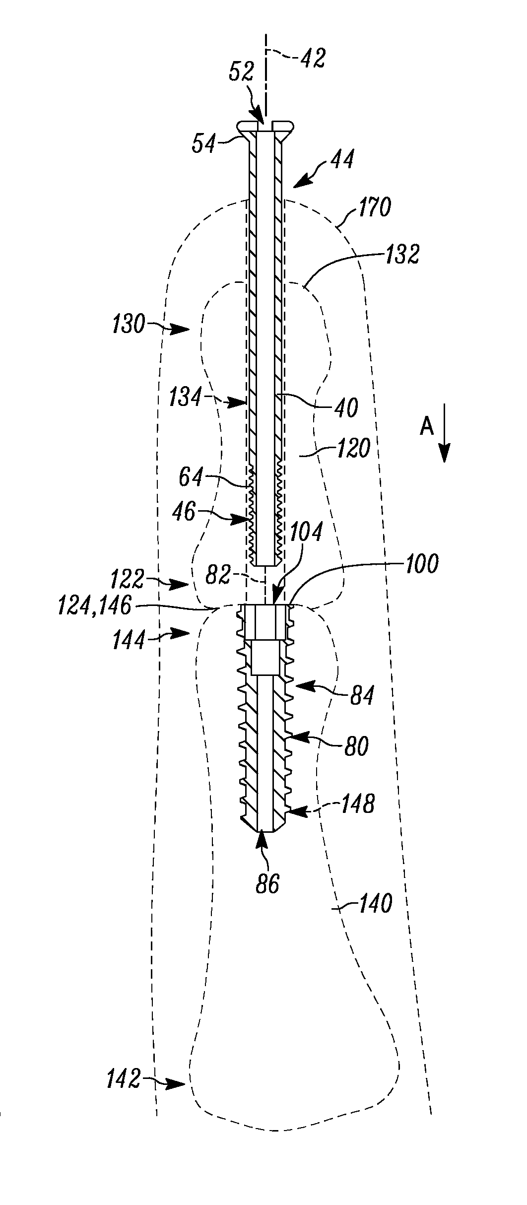 Arthrodesis device and method of use