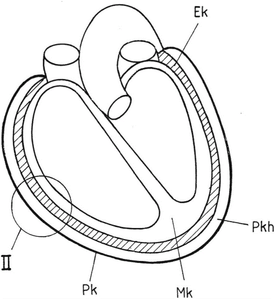 Device for the transcutaneous implantation of epicardial pacemaker electrodes