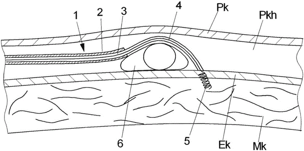 Device for the transcutaneous implantation of epicardial pacemaker electrodes