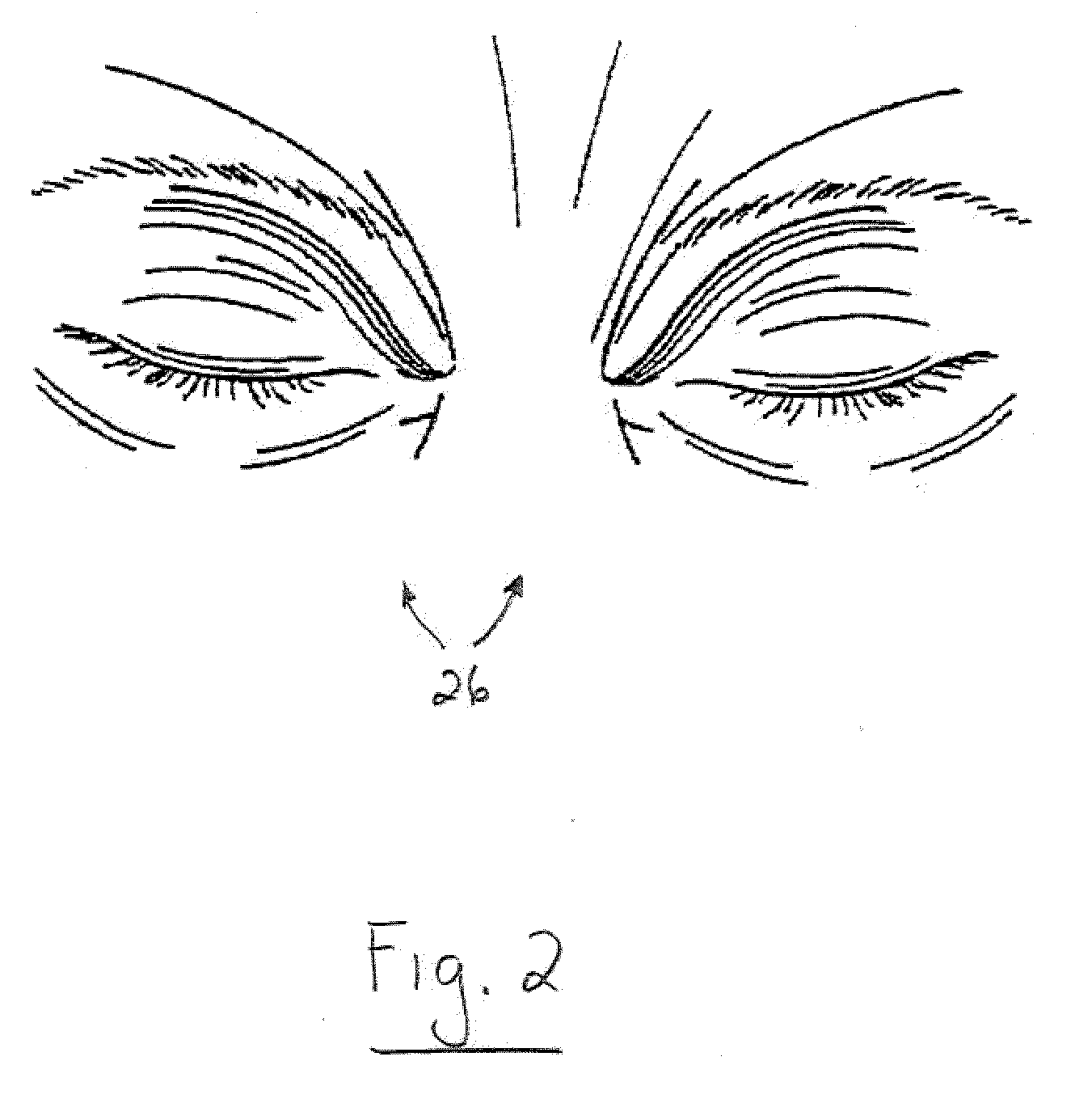 Apparatus and method for treating a neuromuscular defect