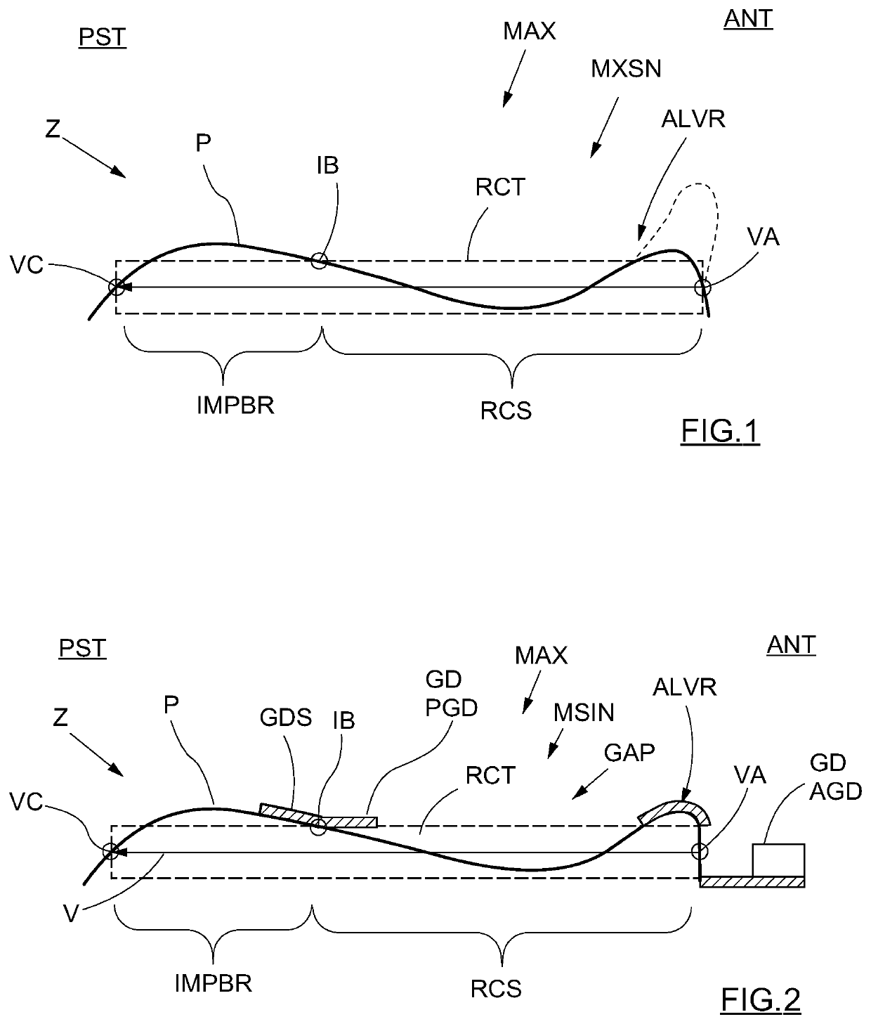 Apparatus for zygomatic implantation and method