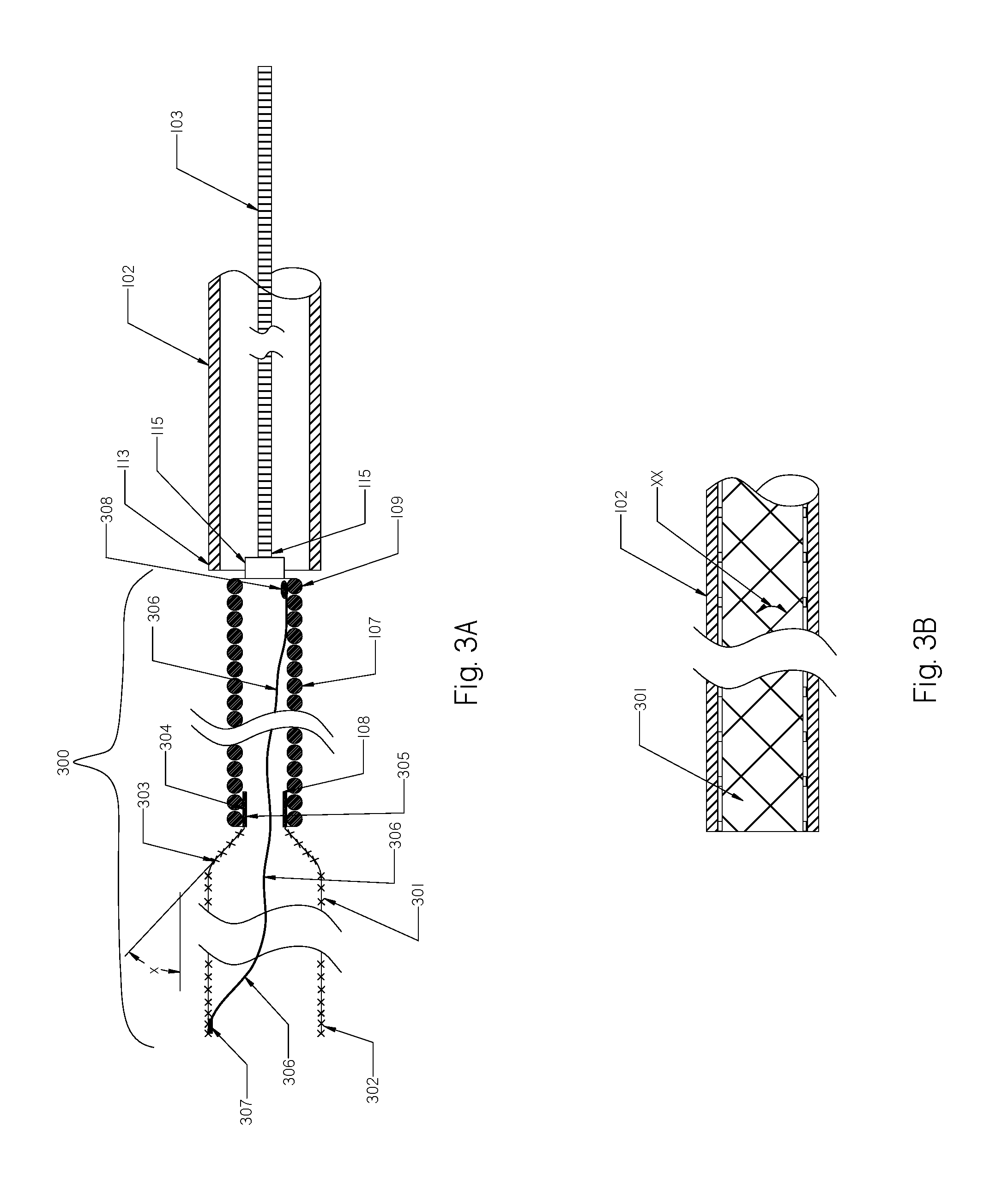 Devices and Methods for Treatment of Endovascular and Non-Endovascular Defects in Humans Using Occlusion Implants