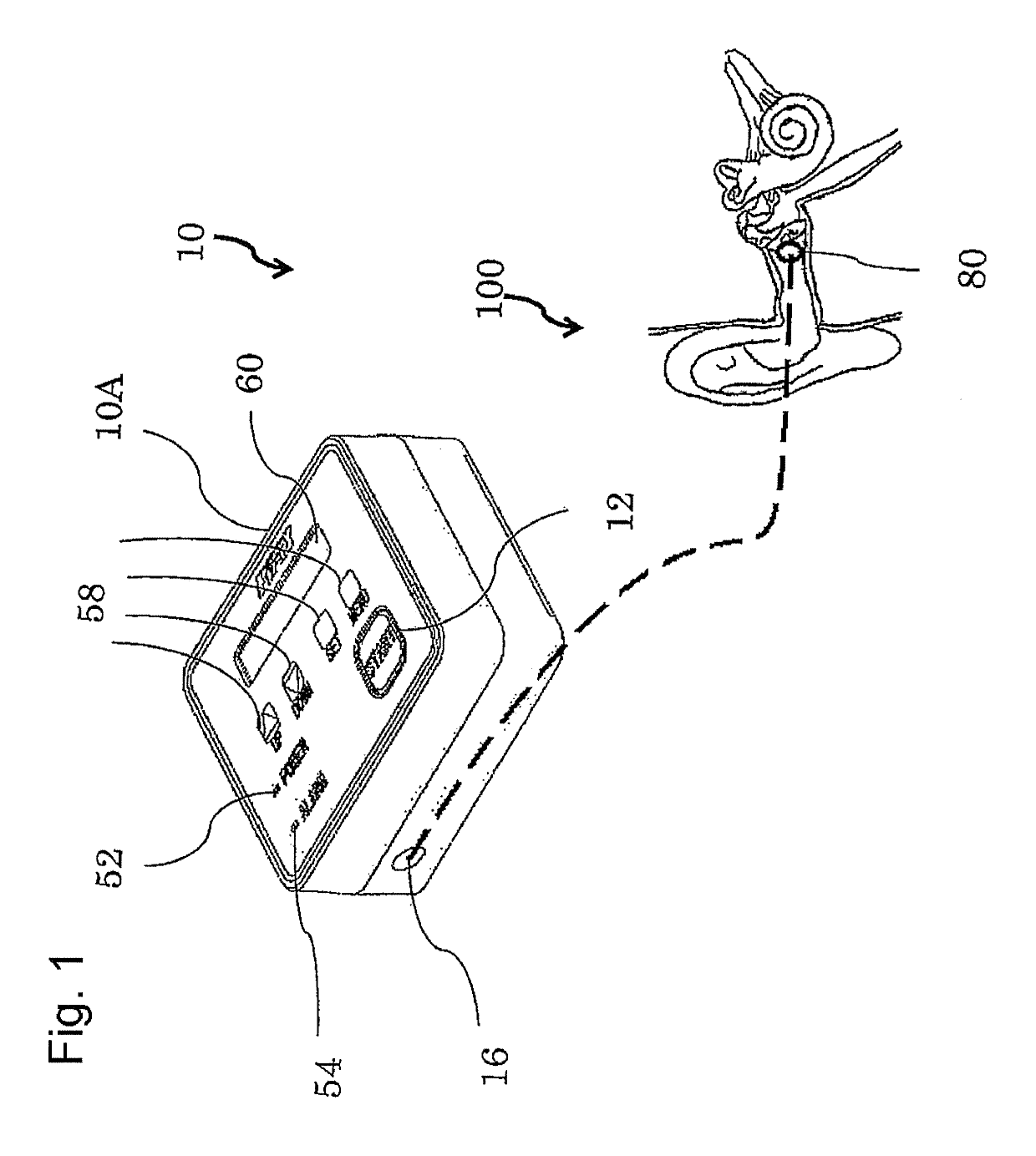 Portable device for treating Meniere's disease and similar conditions