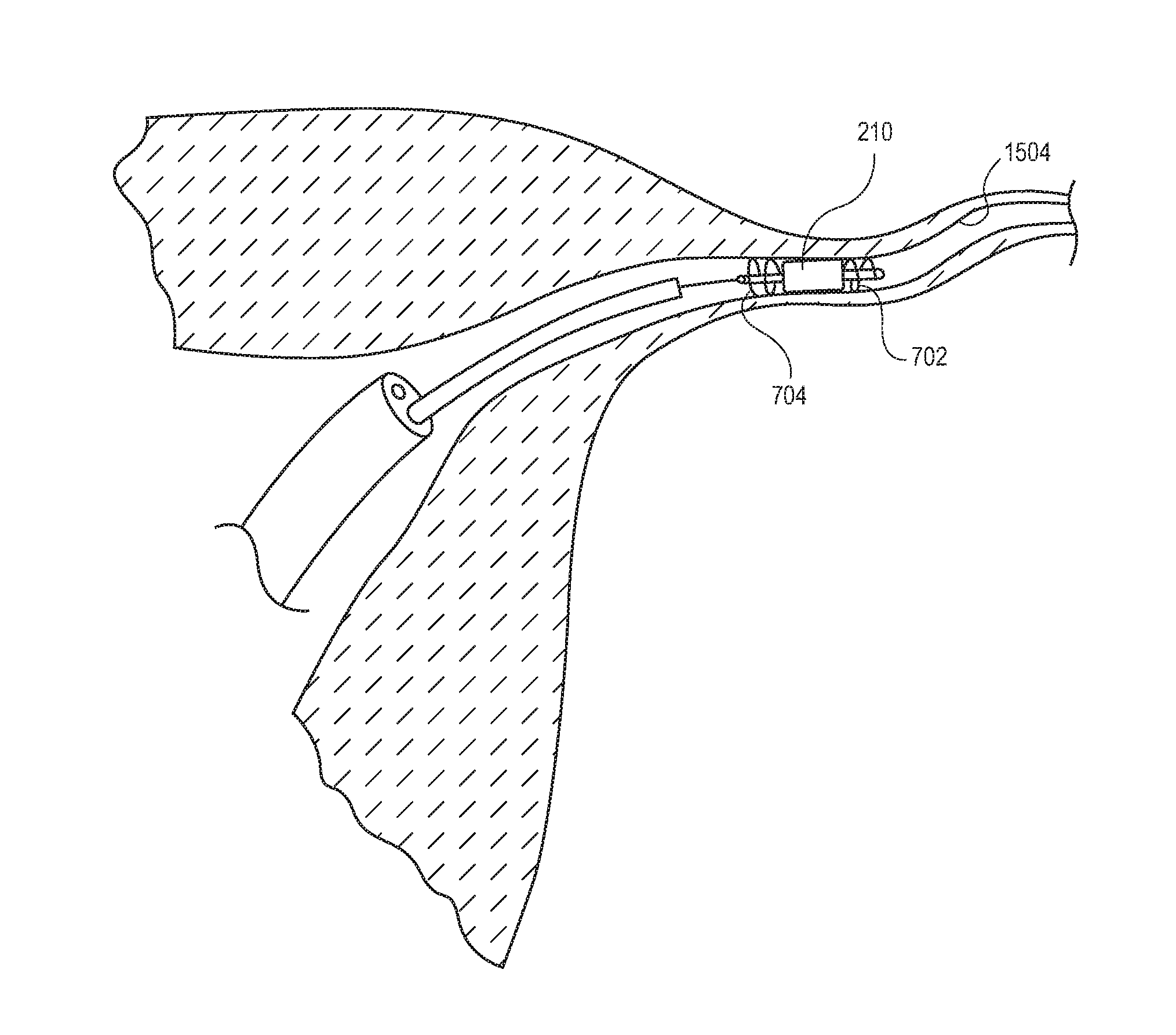 Occlusion device with openable channel