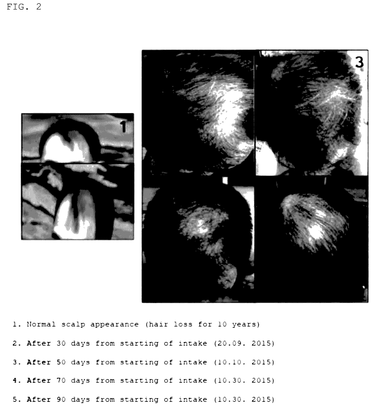 Edible cricket composition for preventing hair loss, improving hair follicle, and promoting hair regrowth