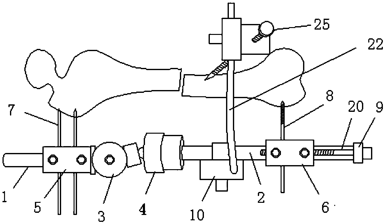 Auxiliary reduction apparatus for closed reduction of femoral shaft fracture of children