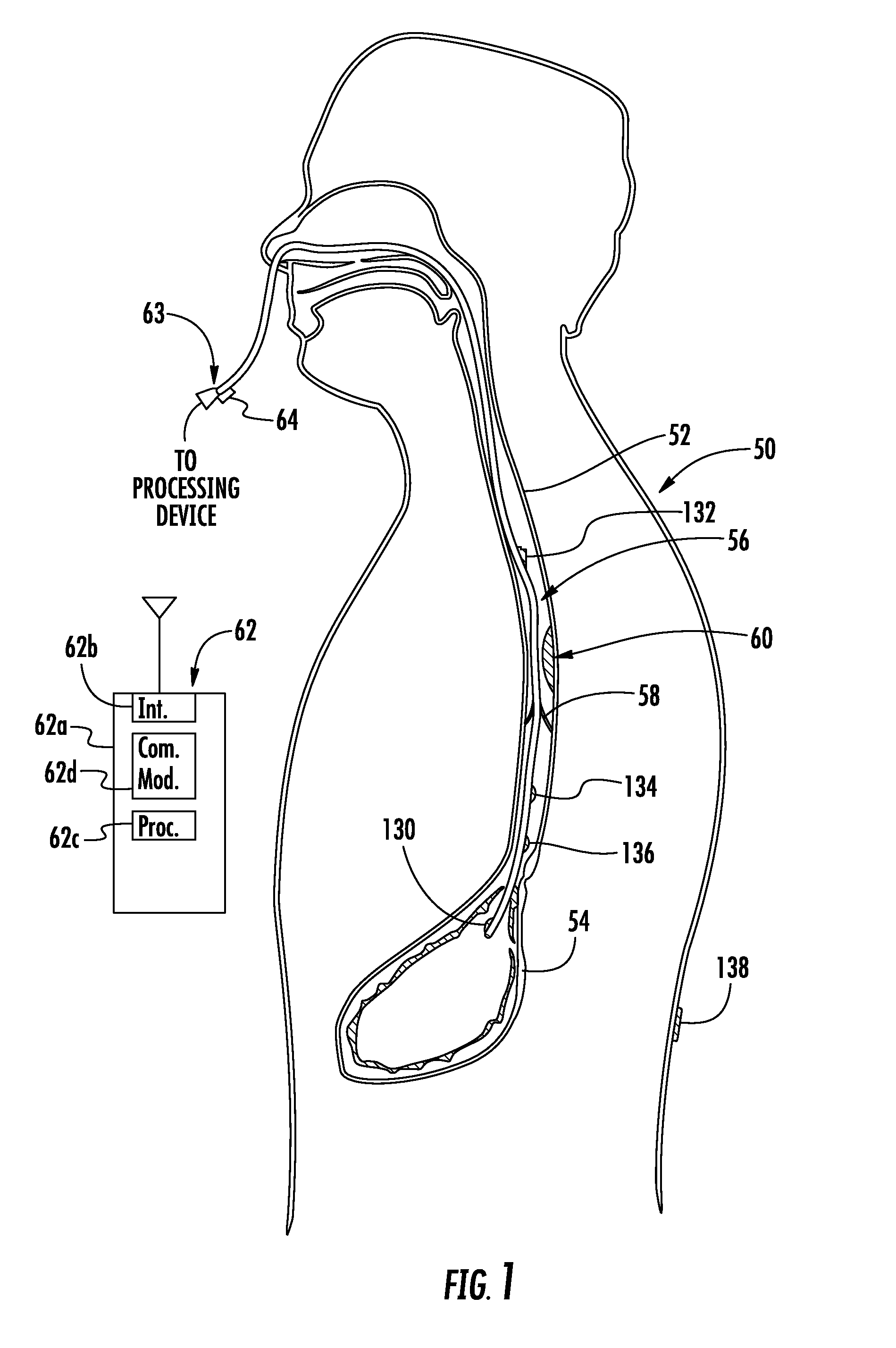 Device to block emesis and reflux and associated system and method