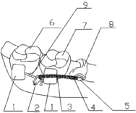 Mandibular premolar residual root traction device