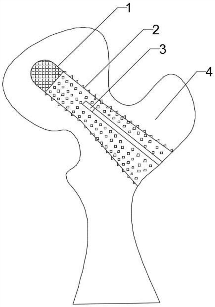 Femoral head supporting device for treating femoral head necrosis