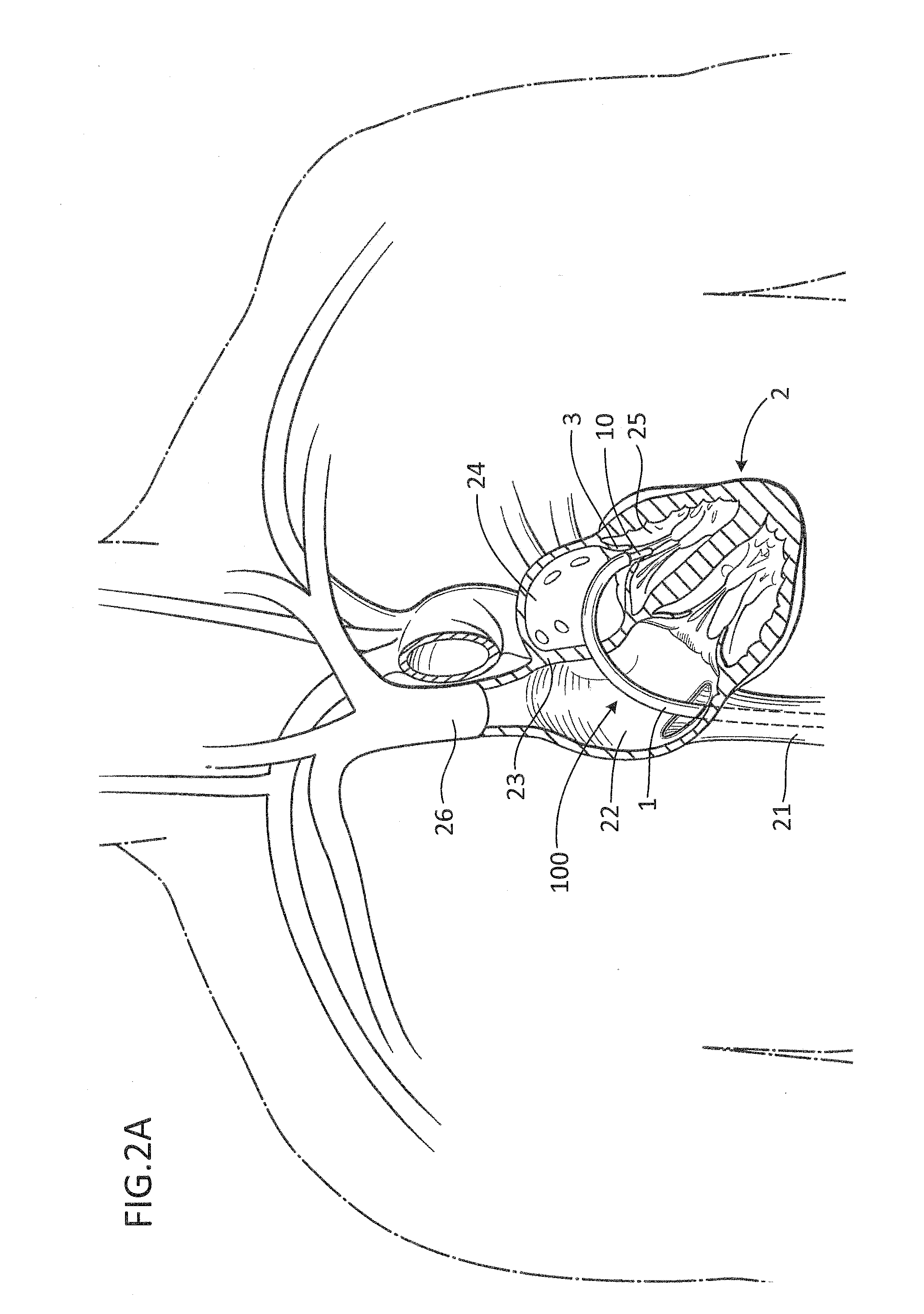 Devices, systems and methods for delivering a prosthetic mitral valve and anchoring device