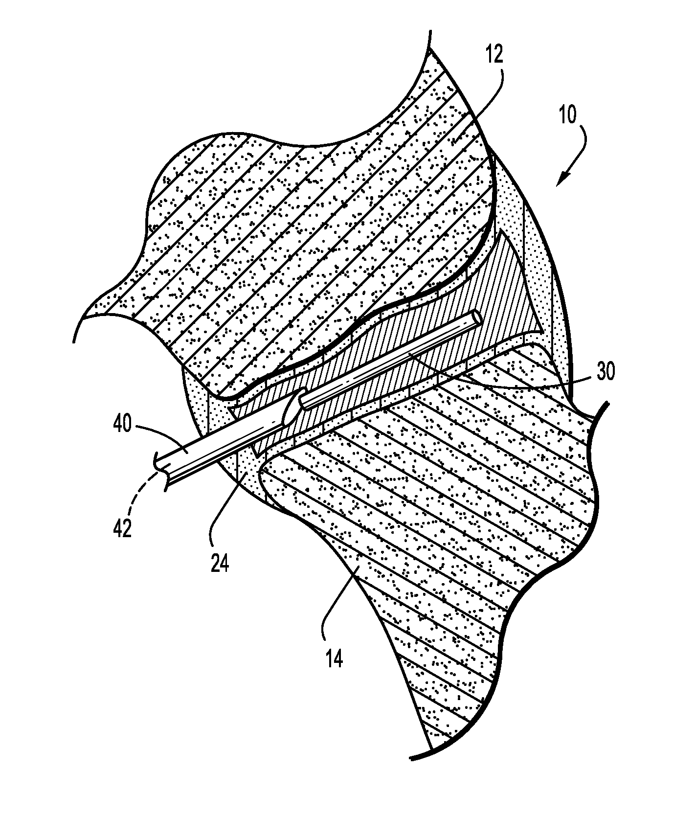 Spinal facet augmentation implant and method