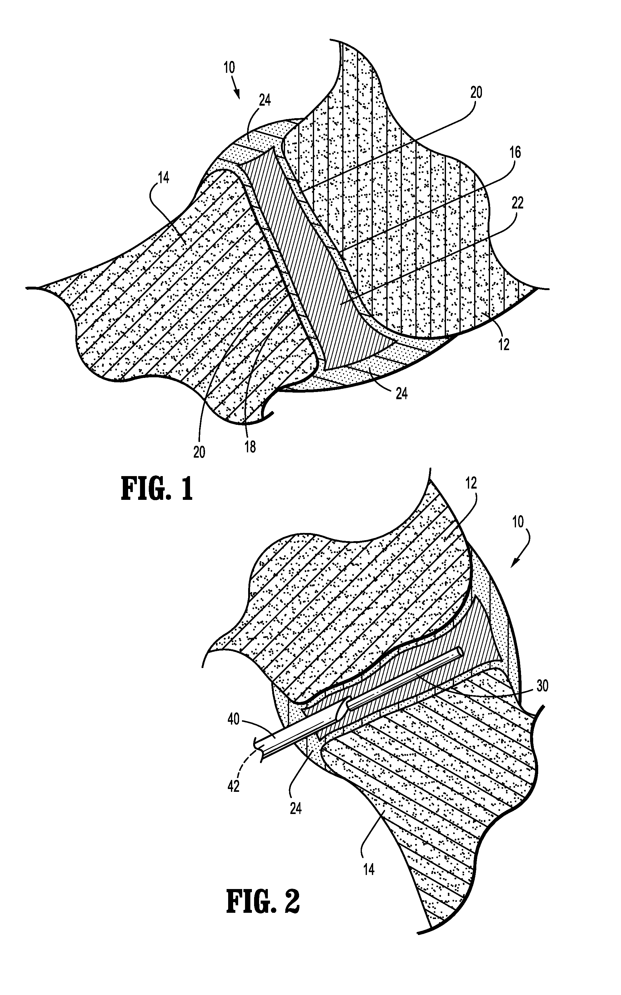Spinal facet augmentation implant and method
