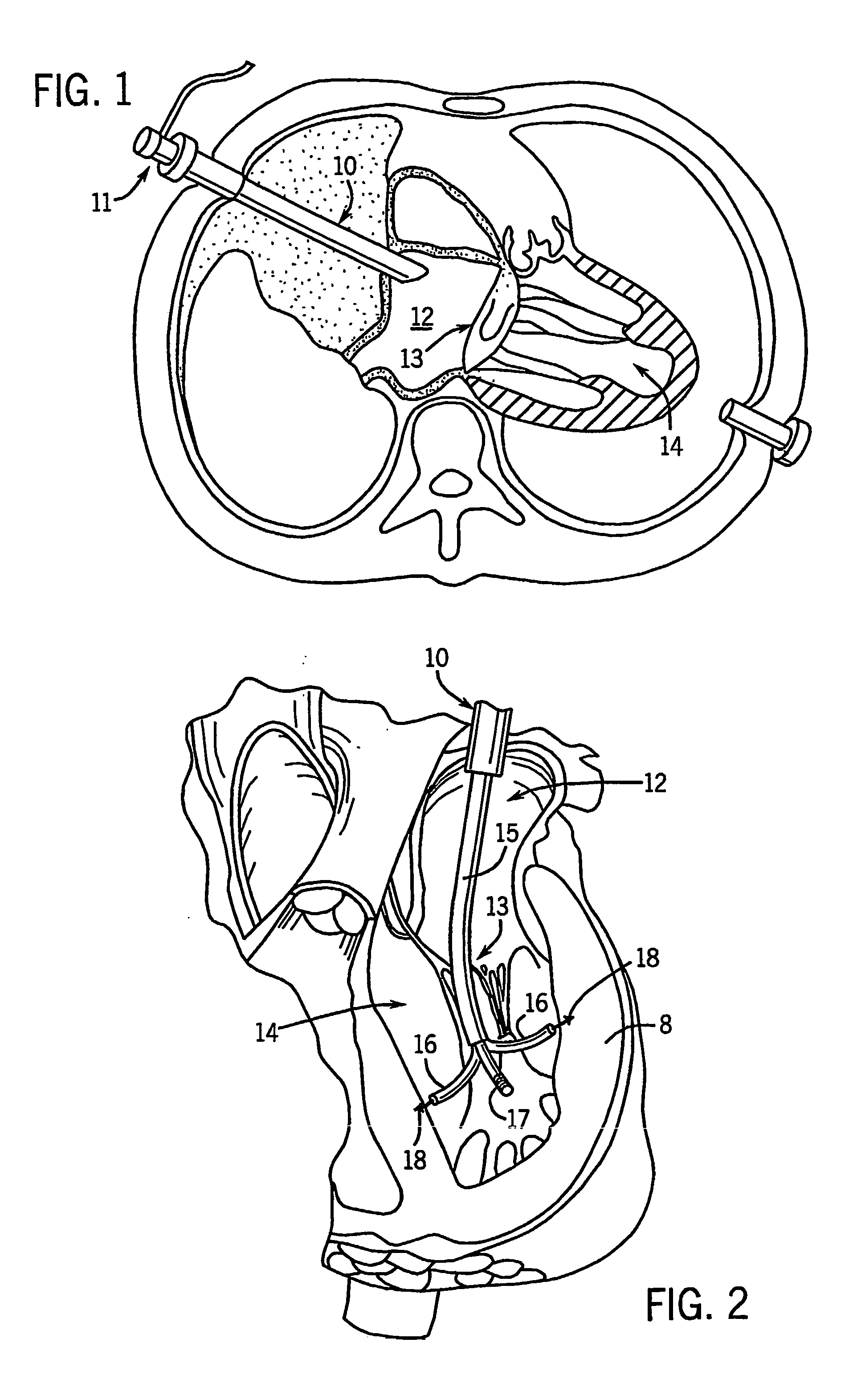 Device and method for treating congestive heart failure