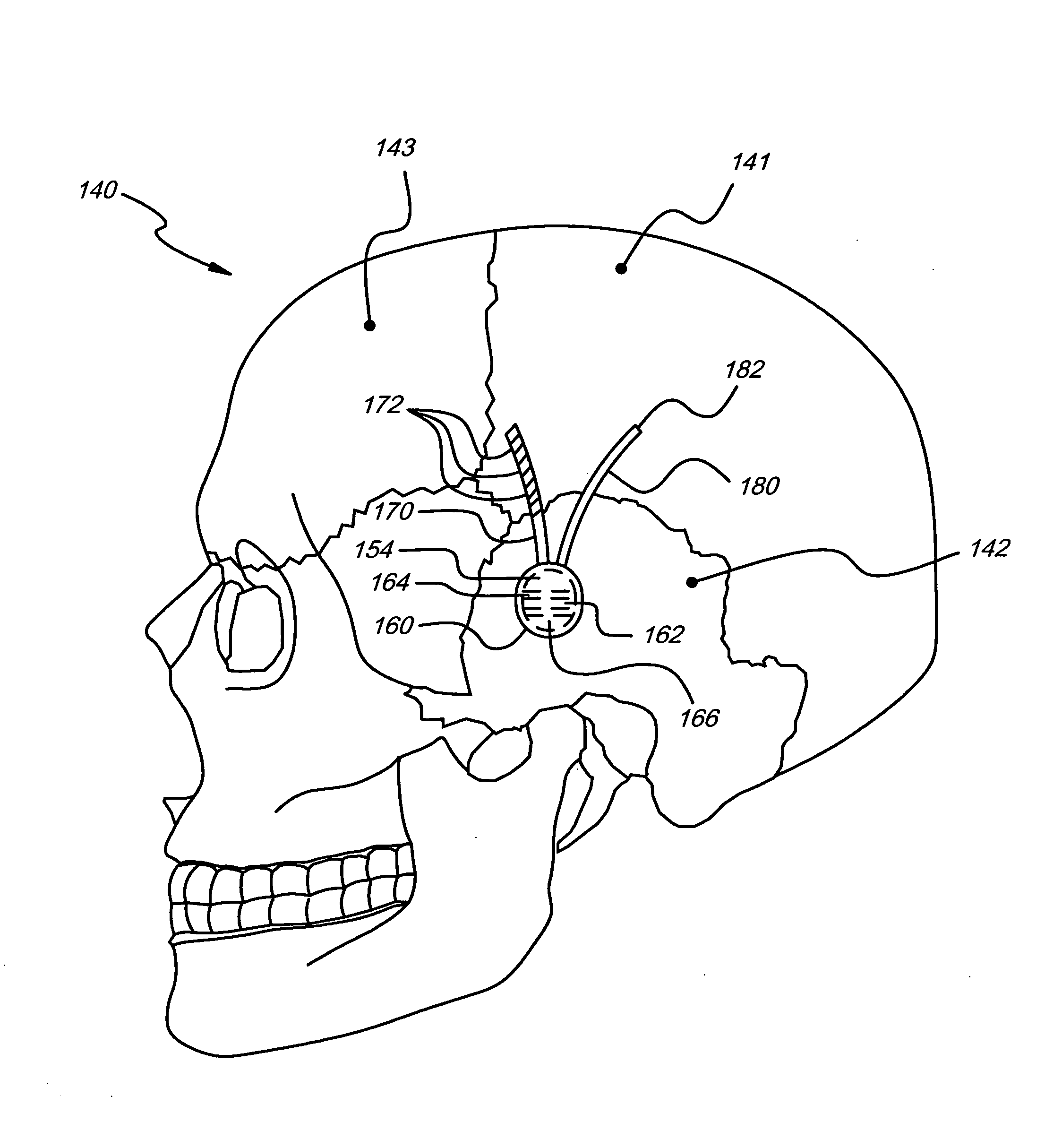 Treatment of aphasia by electrical stimulation and/or drug infusion