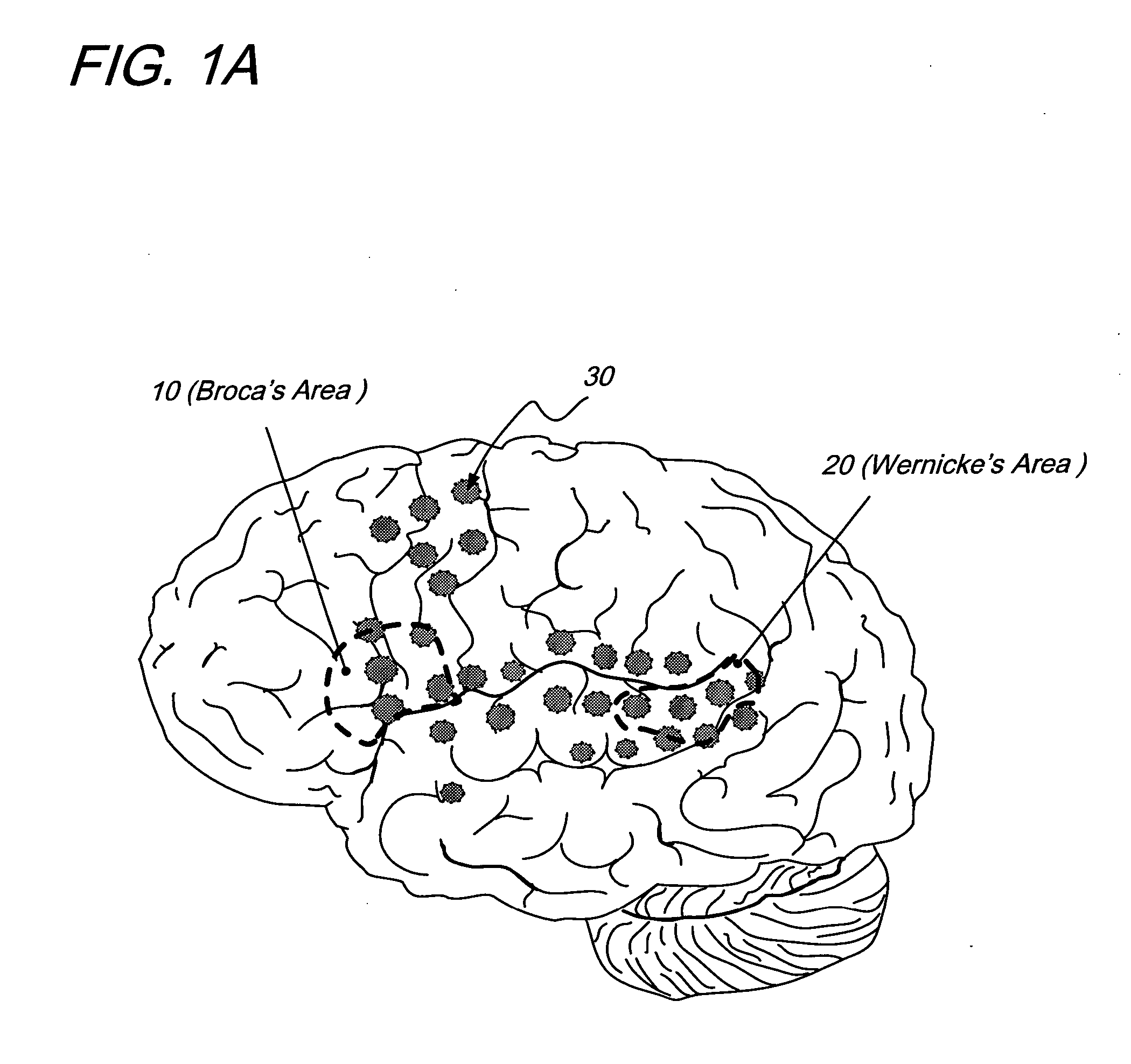 Treatment of aphasia by electrical stimulation and/or drug infusion