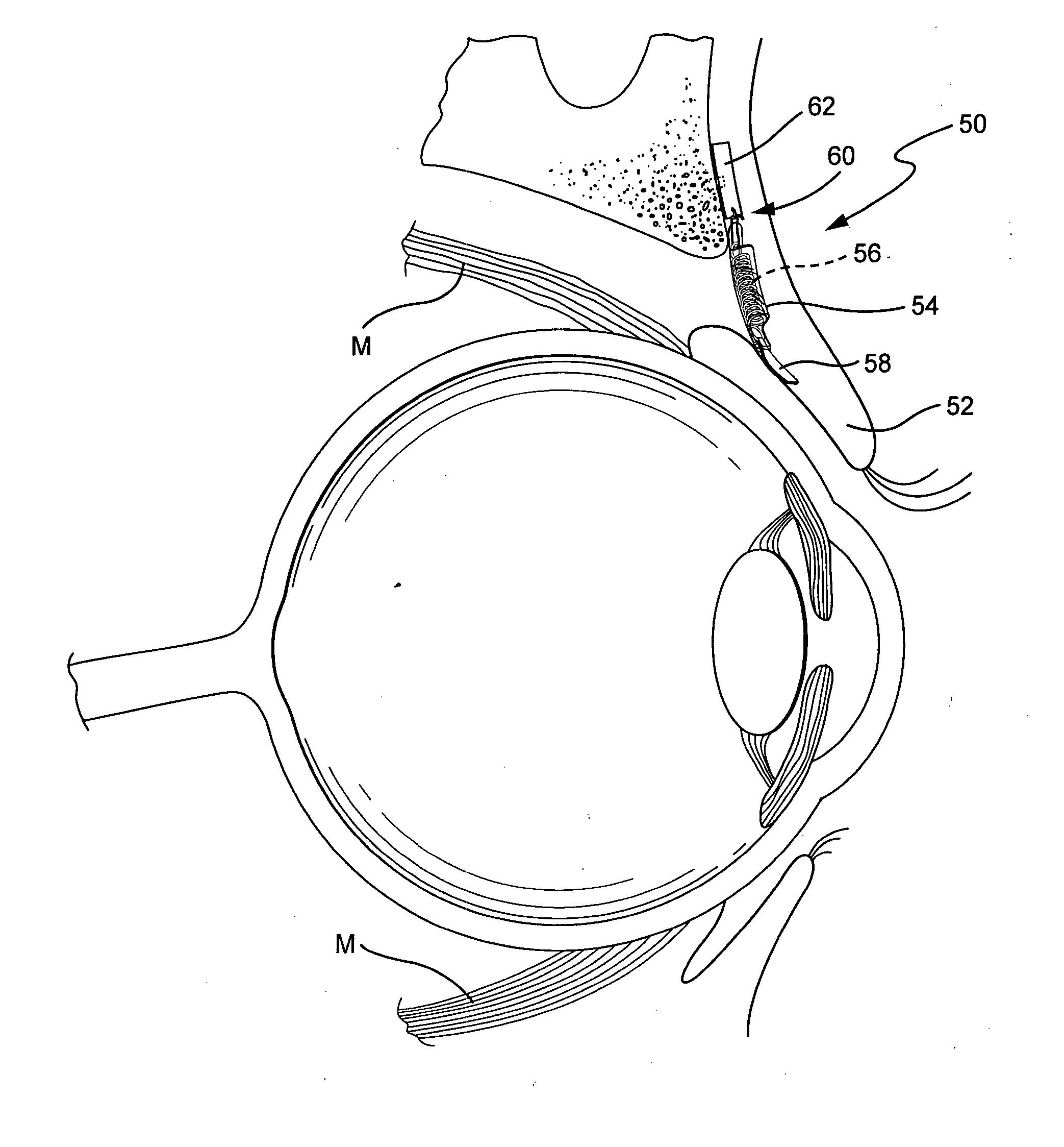 Extraocular muscle prosthesis