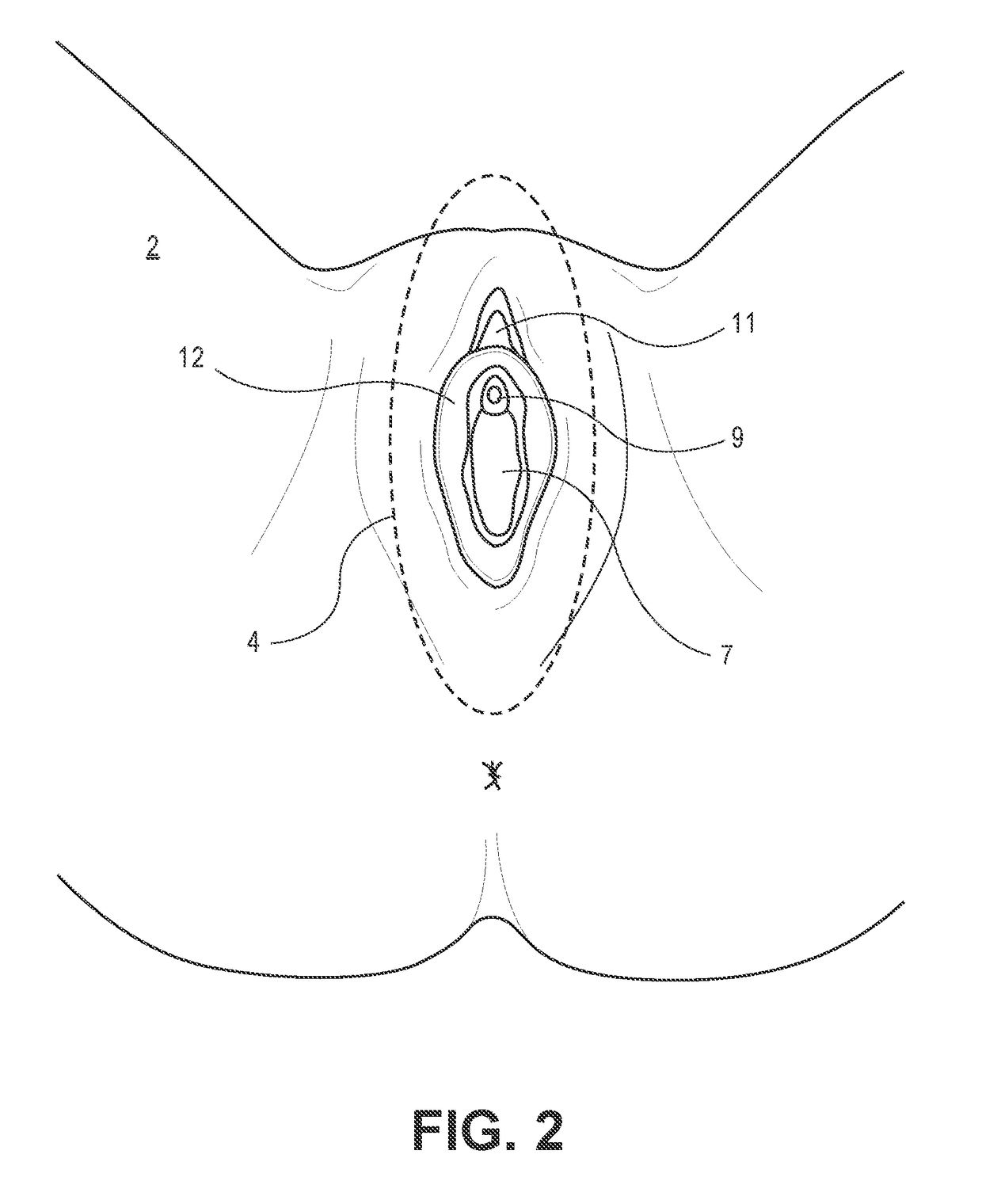 Device and method to treat vaginal atrophy