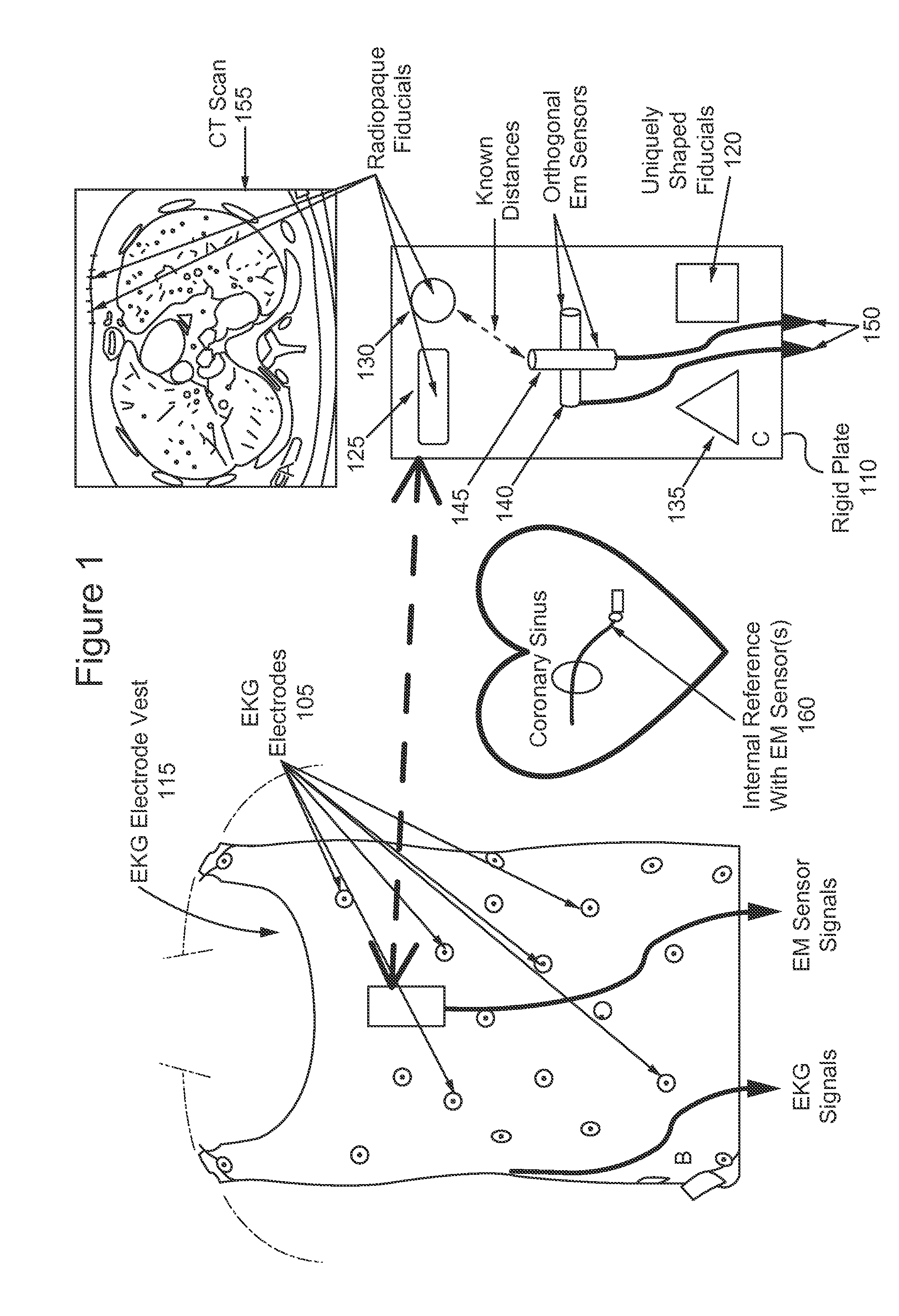 System and methods for using body surface cardiac electrogram information combined with internal information to deliver therapy