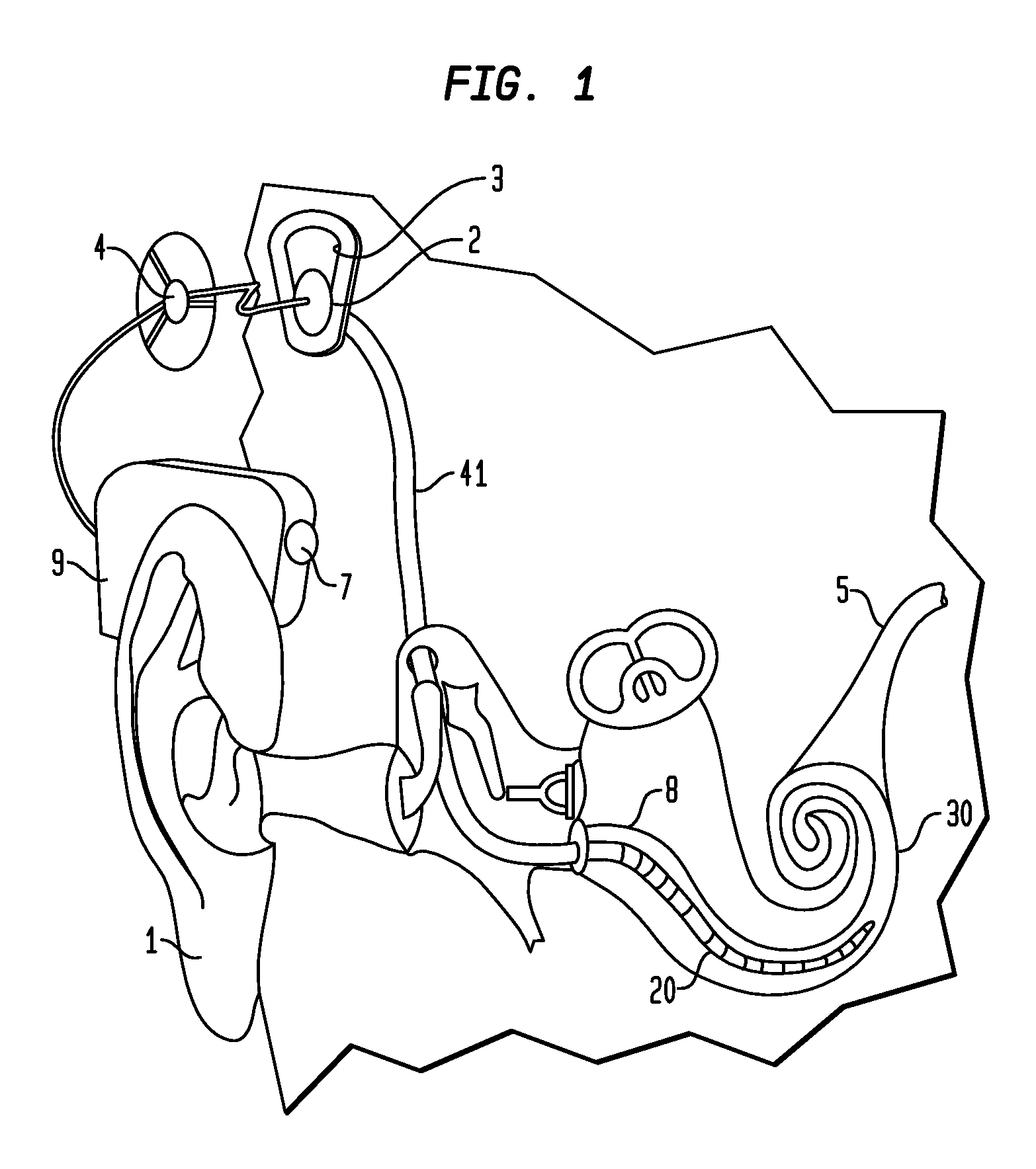 Apparatus for delivery of pharmaceuticals to the cochlea