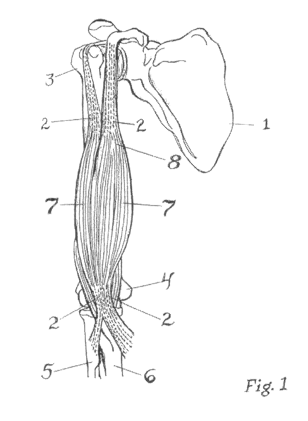 Taping method for inhibition of skeletal muscle tone