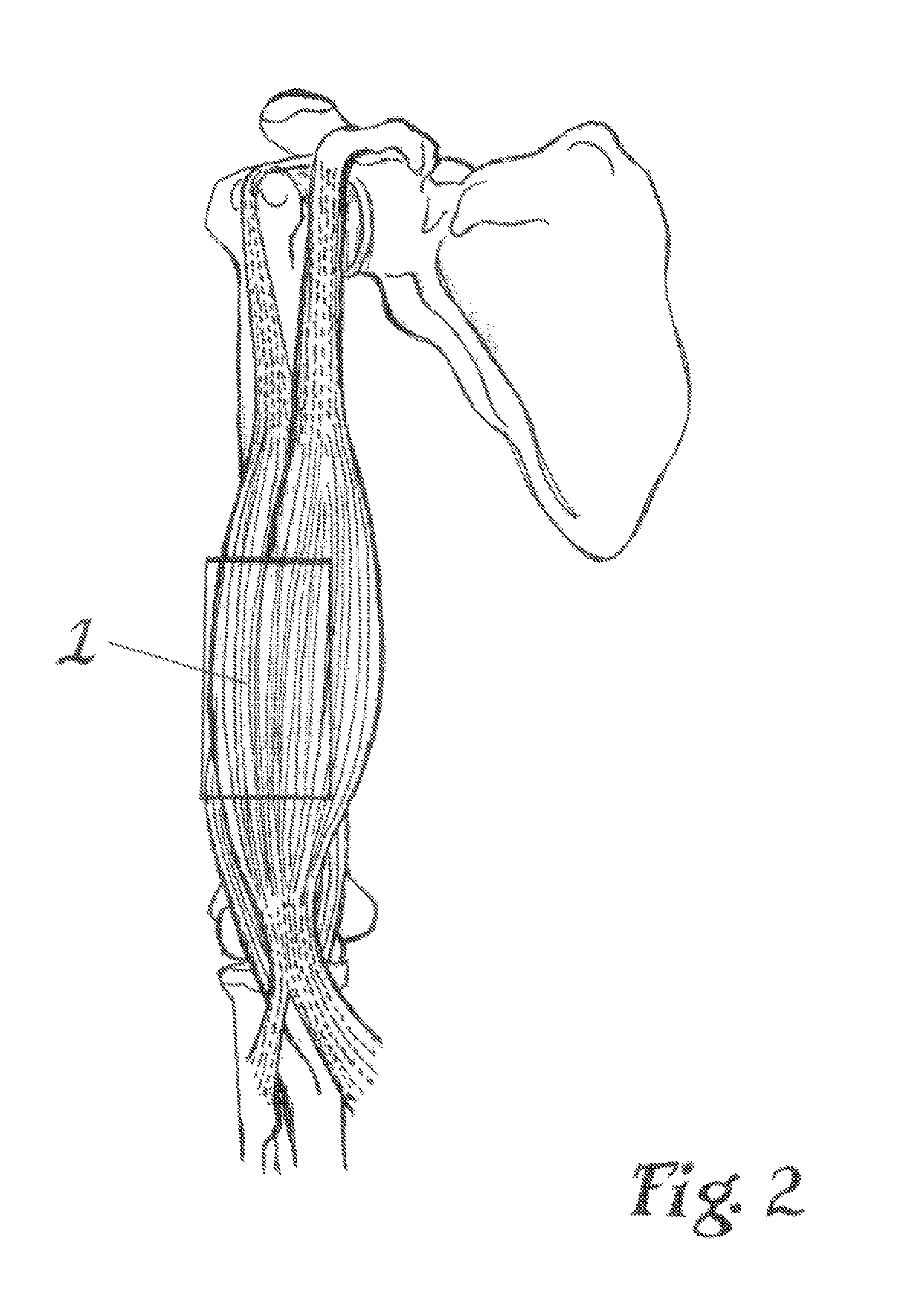 Taping method for inhibition of skeletal muscle tone