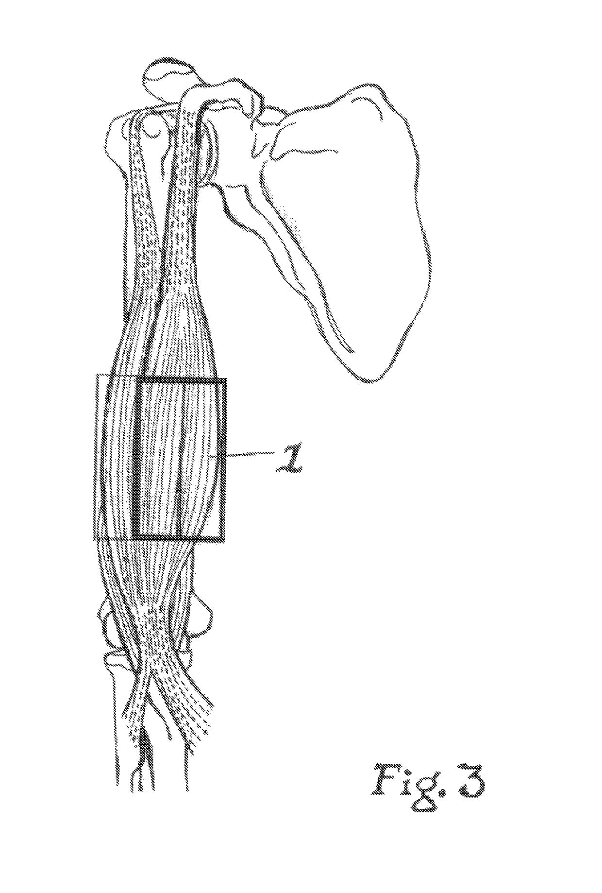 Taping method for inhibition of skeletal muscle tone