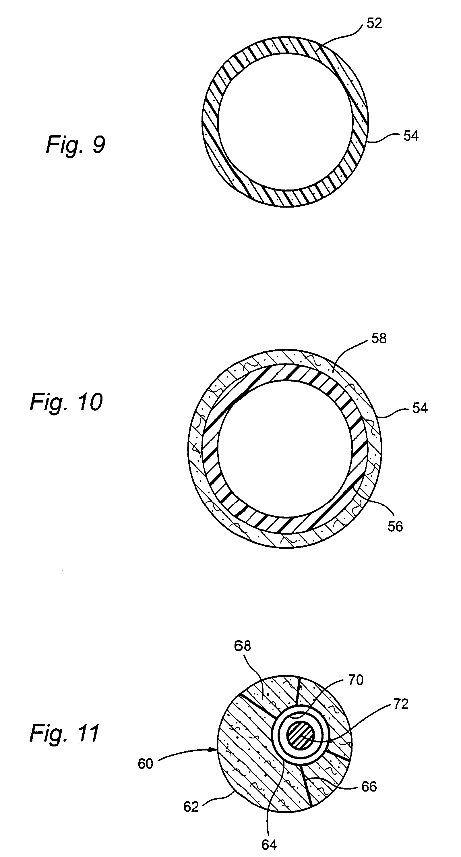 Multi-material incontinence treatment construction device