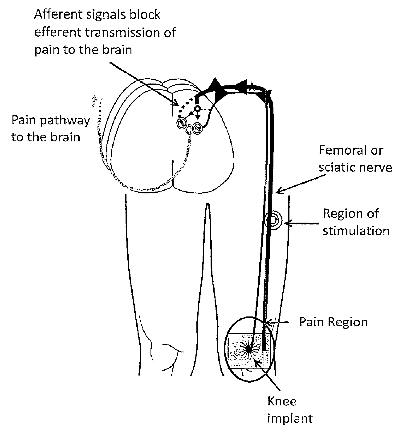 System and method for treatment of pain related to limb joint replacement surgery