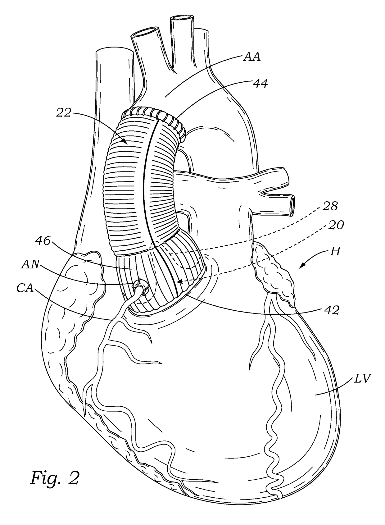Aortic valve and conduit graft implant tool