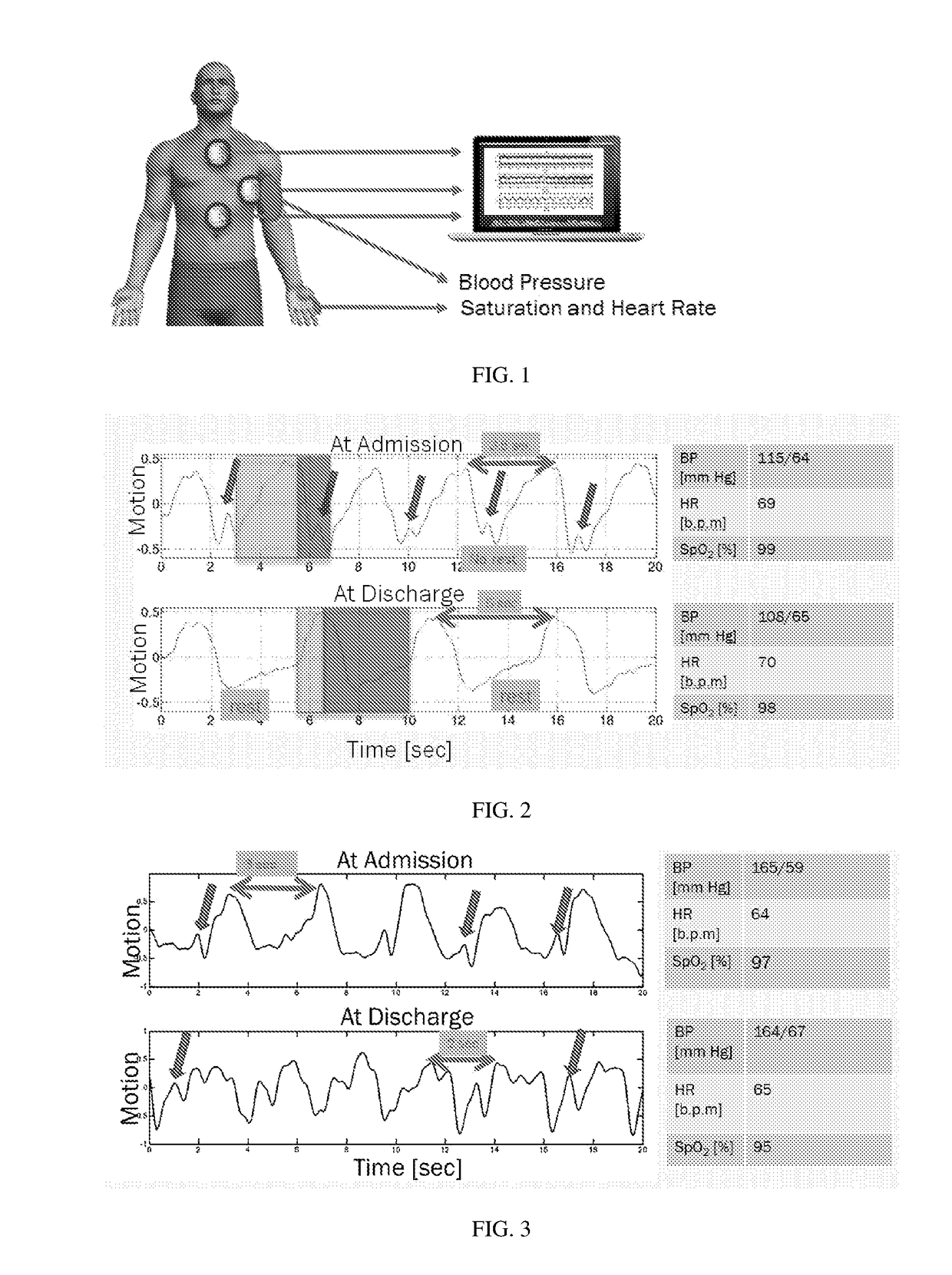 Method device and system for monitoring sub-clinical progression and regression of heart failure
