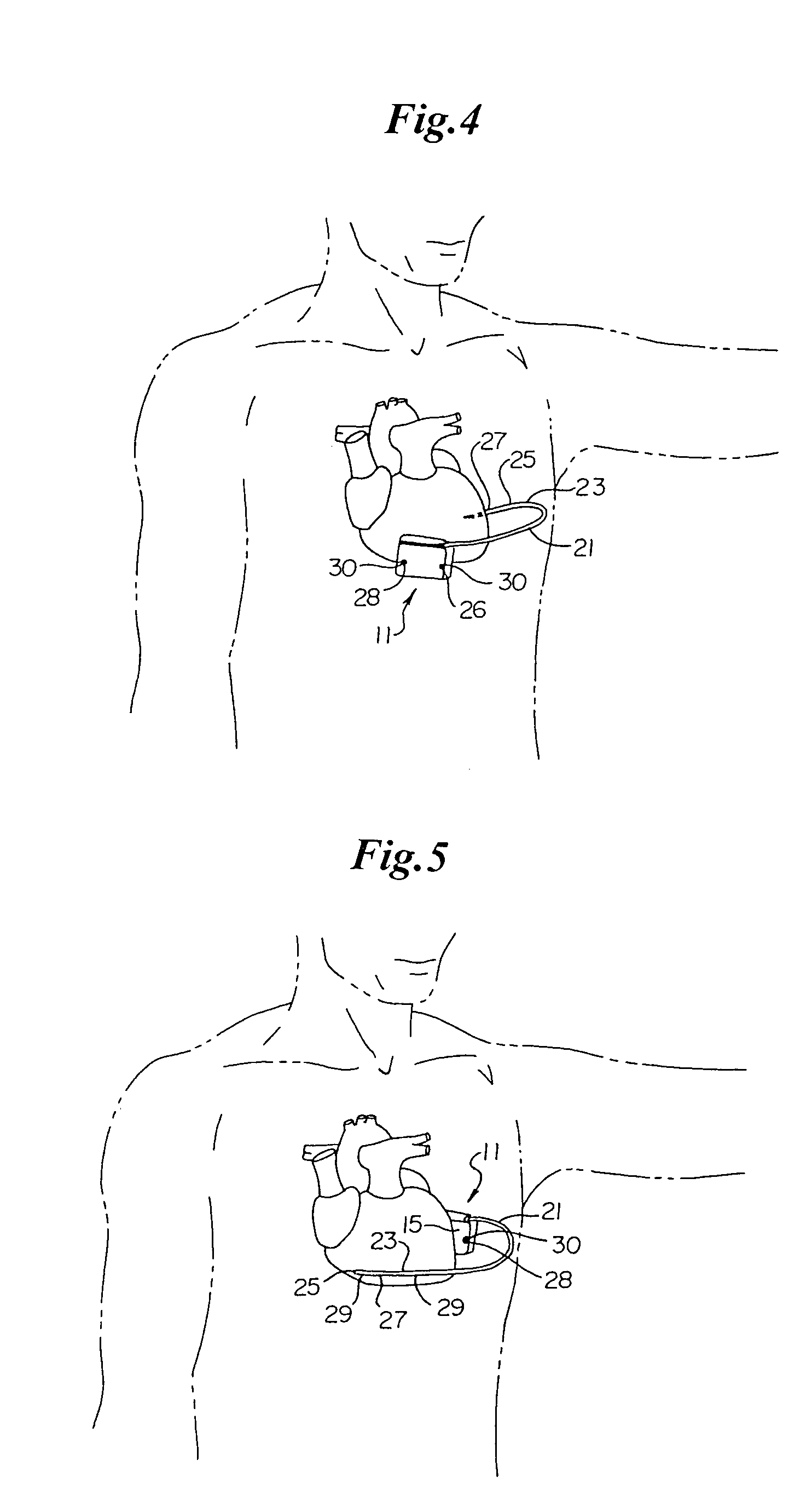 Duckbill-shaped implantable cardioverter-defibrillator canister and method of use